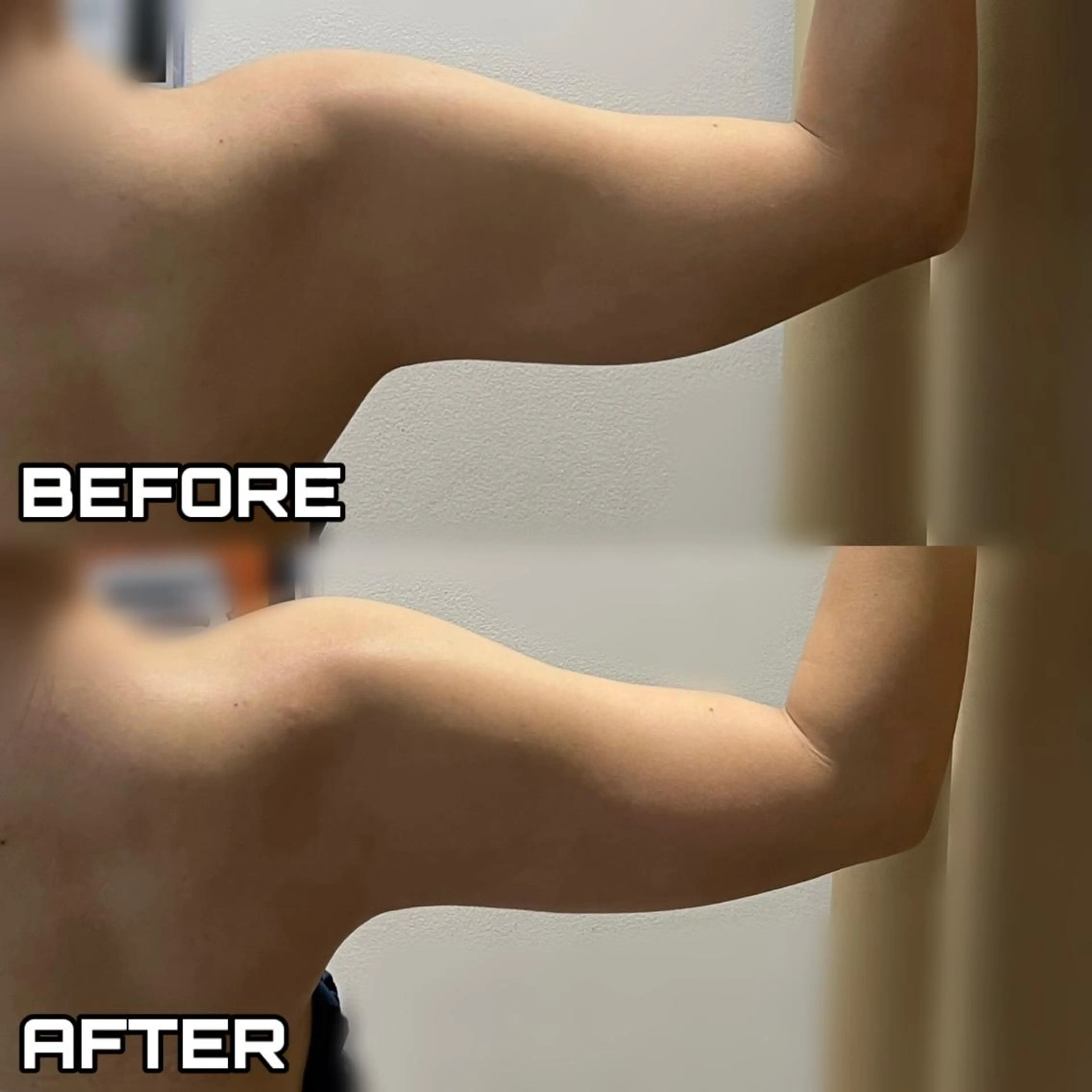 【✨脂肪・たるみ・セルライトまとめてケア】NANIOAFU ボディシェイプ｜1台3役×高コスパ施術〈都度払いOK〉の写真