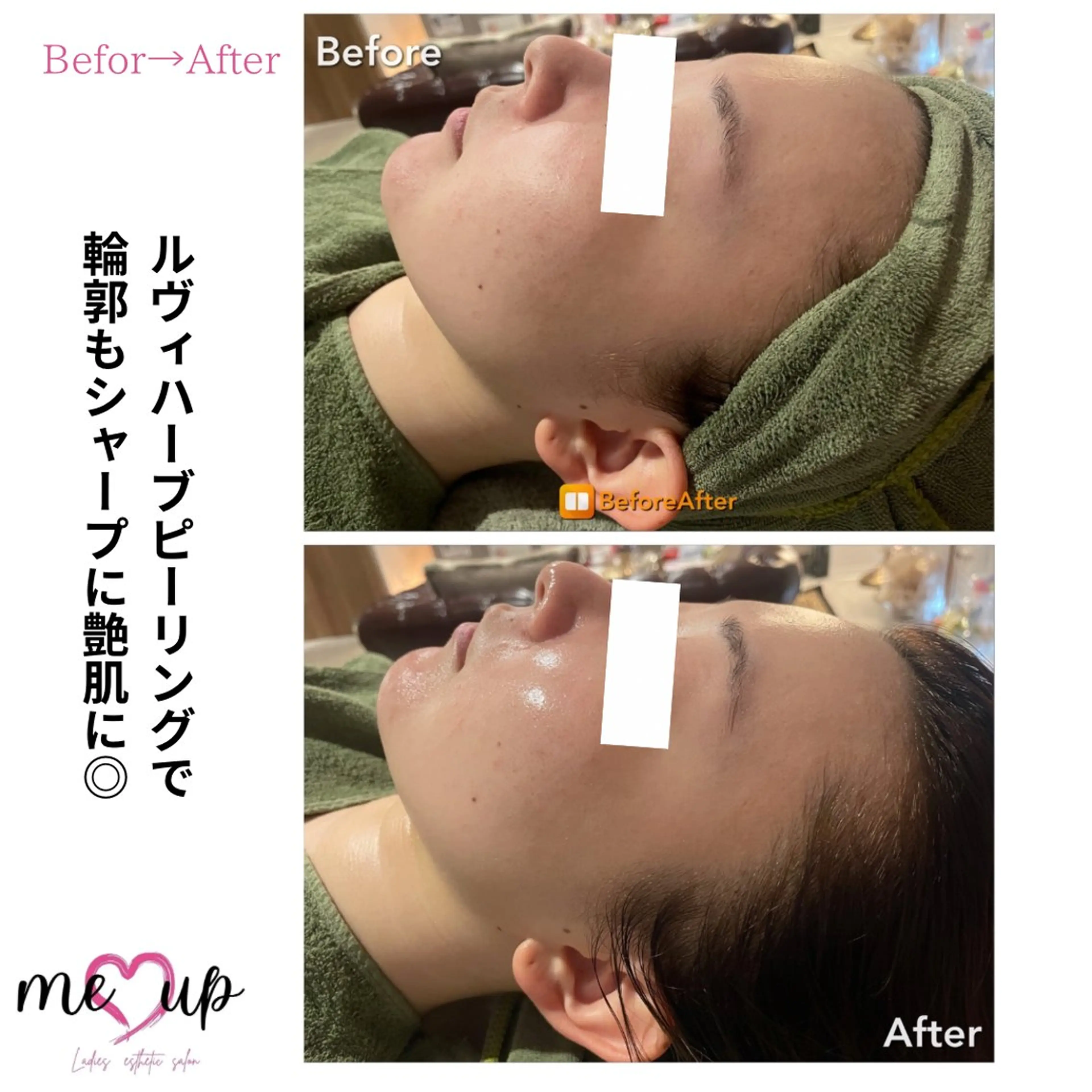 エステ Meupニキビ専門店 背中/ハーブ/肌管理のその他イメージ