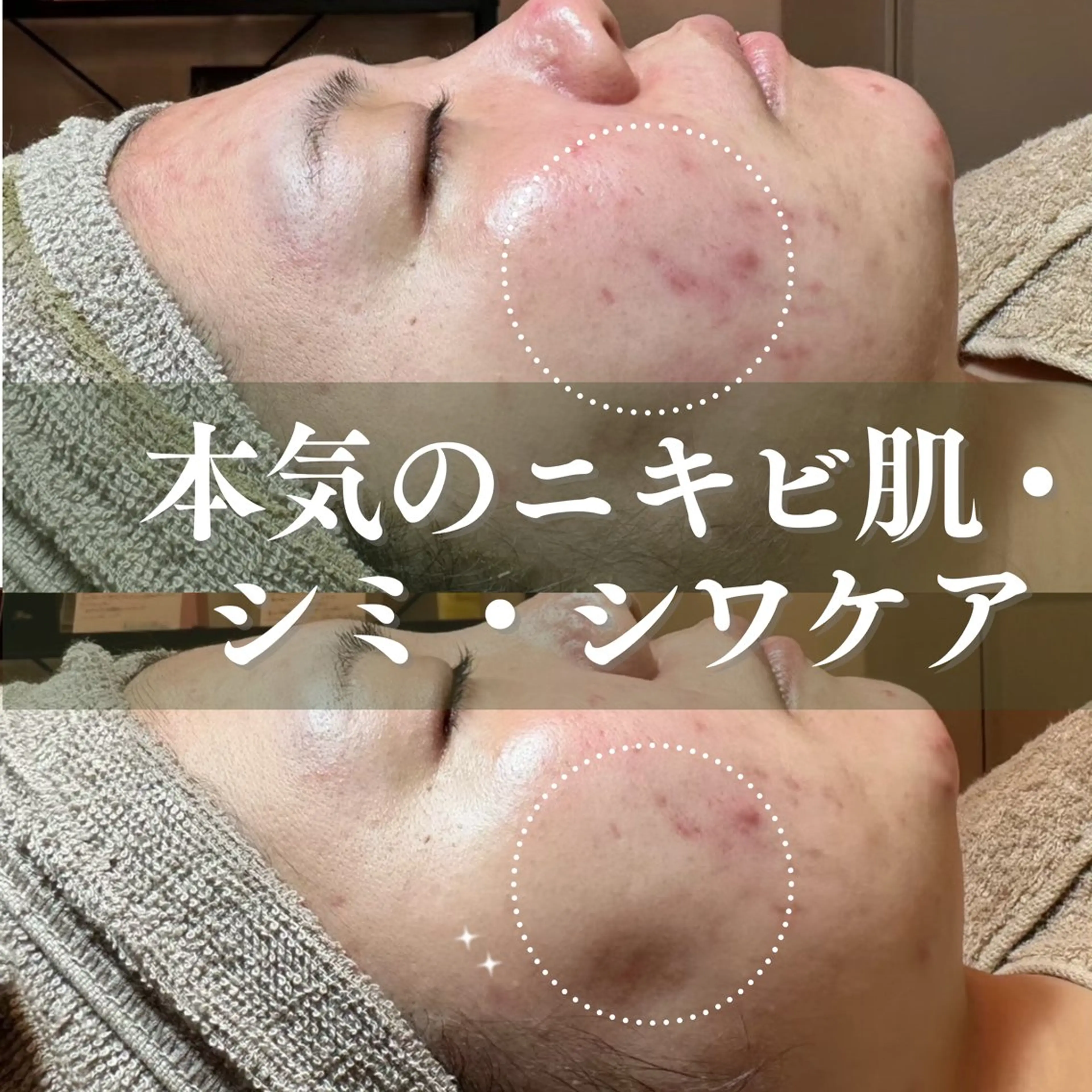 【本気のニキビ肌・シミ・シワケア】剥けないハーブピーリング＋セレクト美容液５種＋ipsp幹細胞仕上げ　定価34,650円の写真