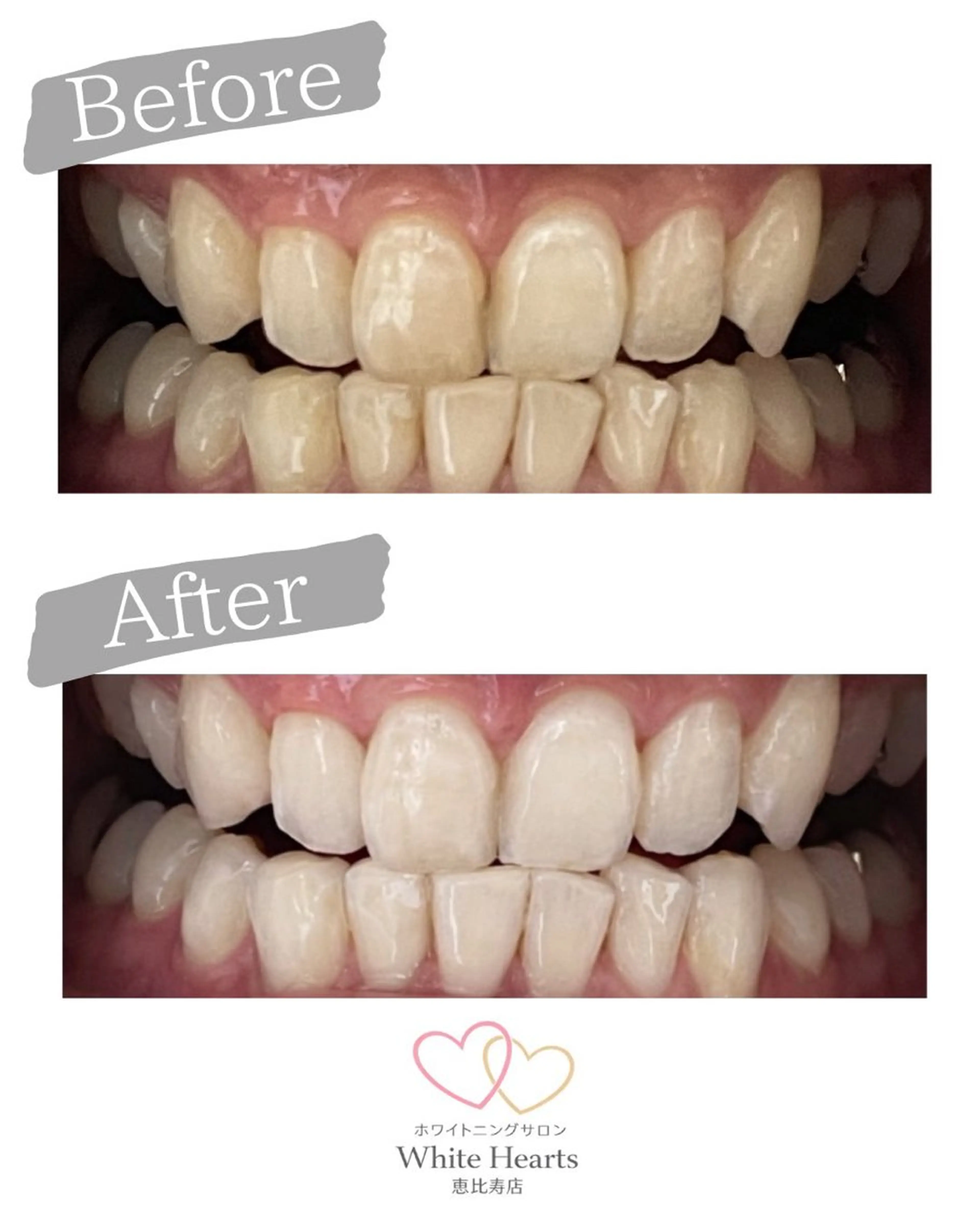 ホワイトニングの写真