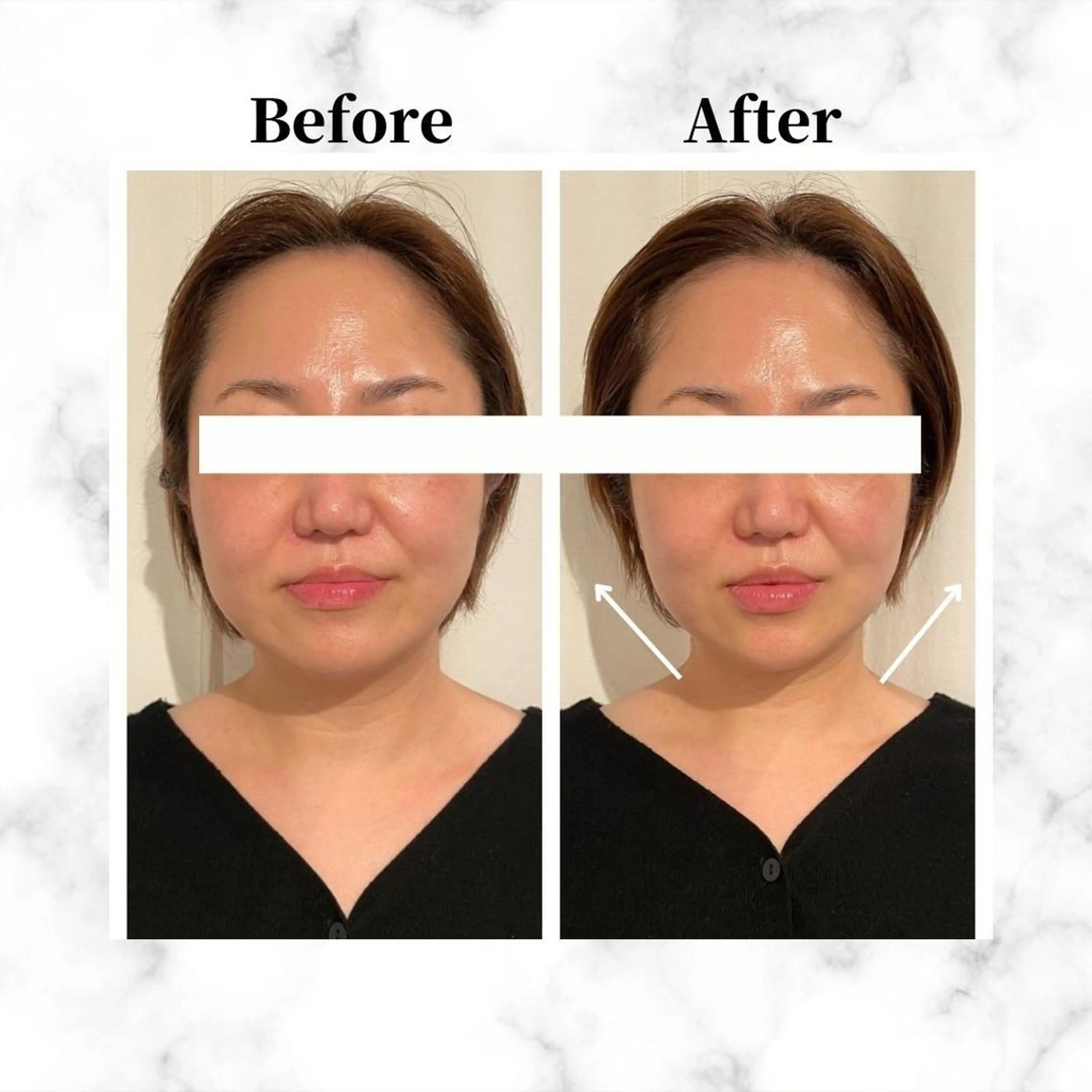 12Dハイフ💗 最強小顔のエステ・リラクイメージ