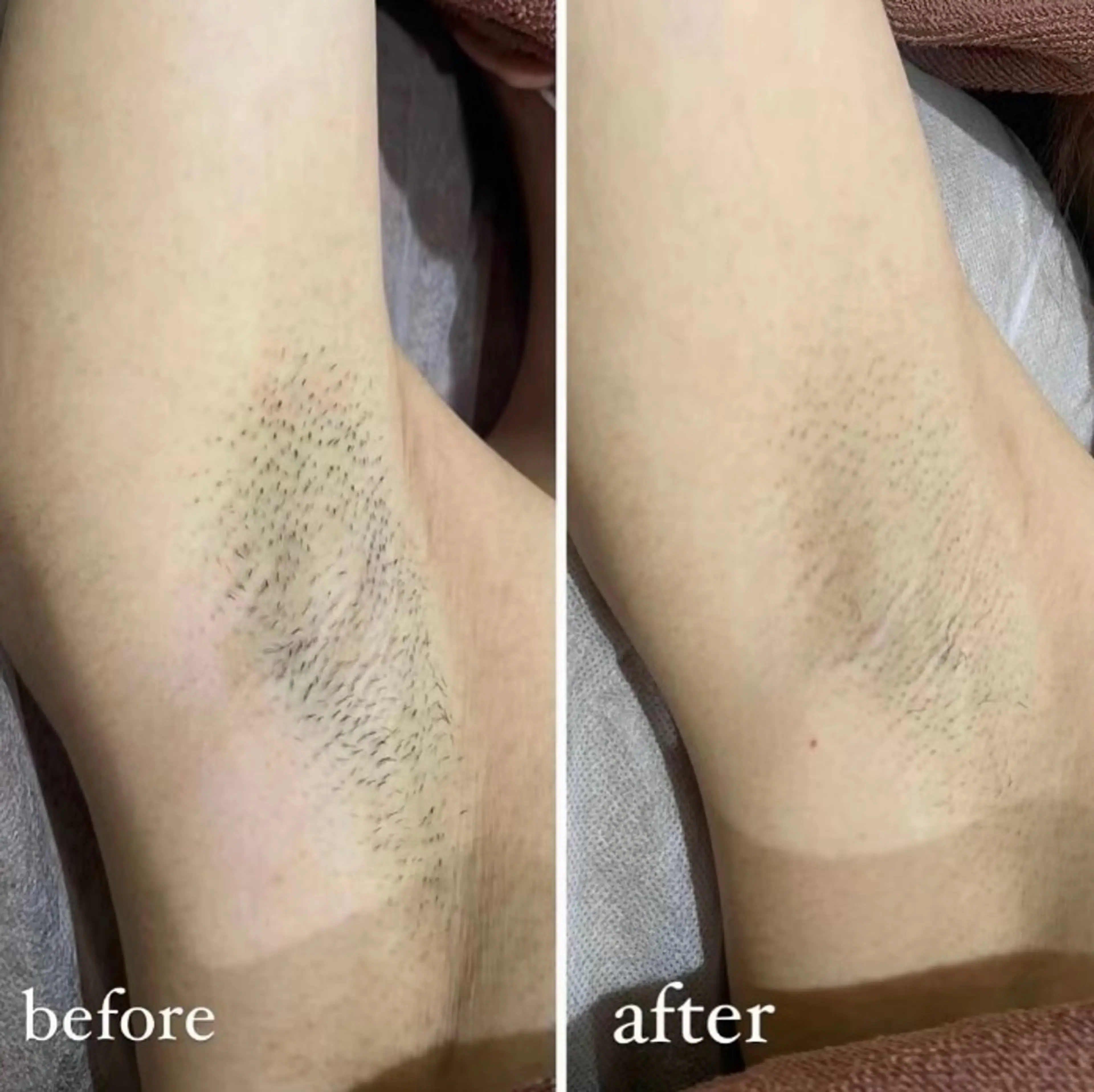 脱毛 トータル美容サロン☆ 脱毛/小顔/毛穴洗浄のエステ・リラクイメージ