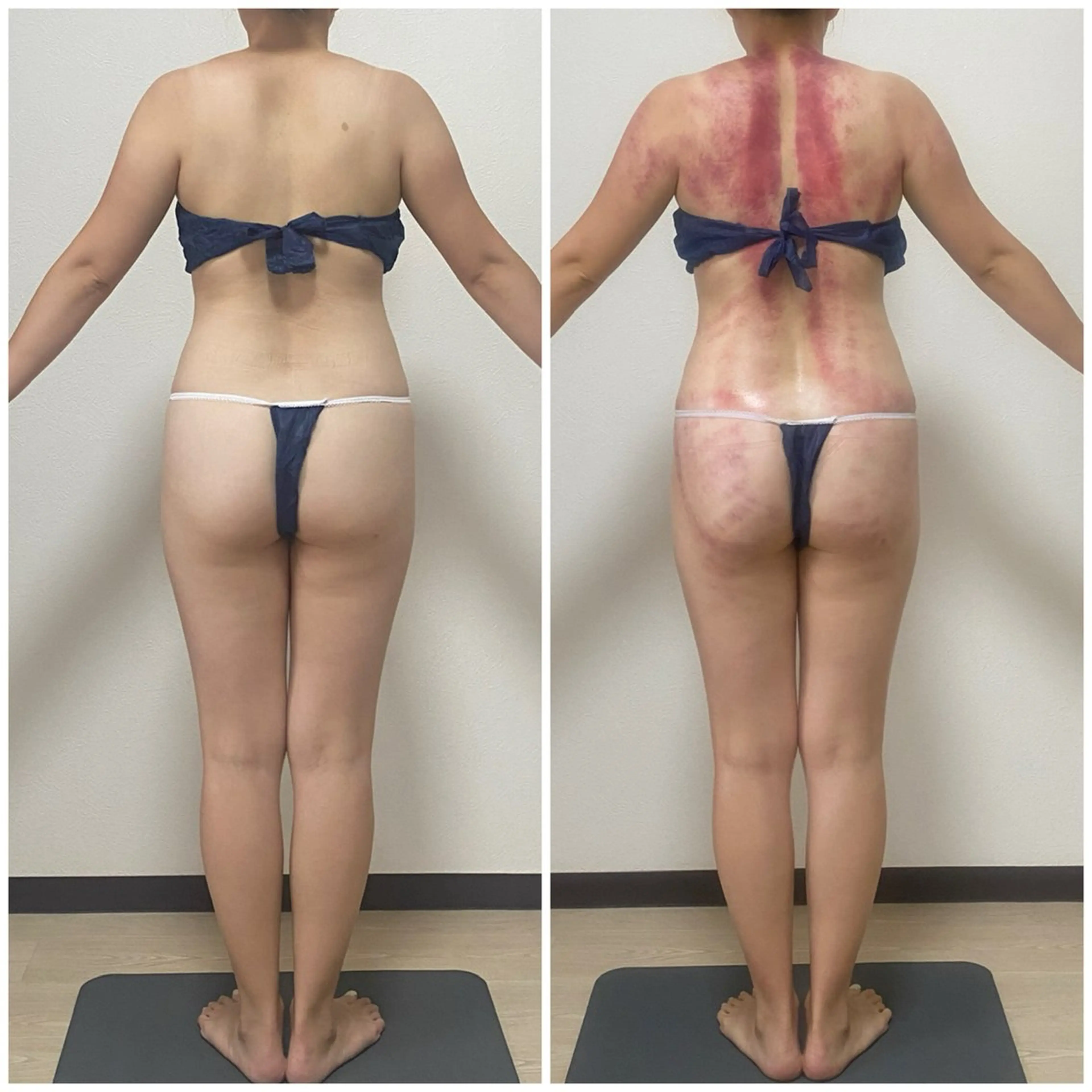 セルライトクラッシュ60分　全身　➕遠赤外縁ヒートマット付きの写真