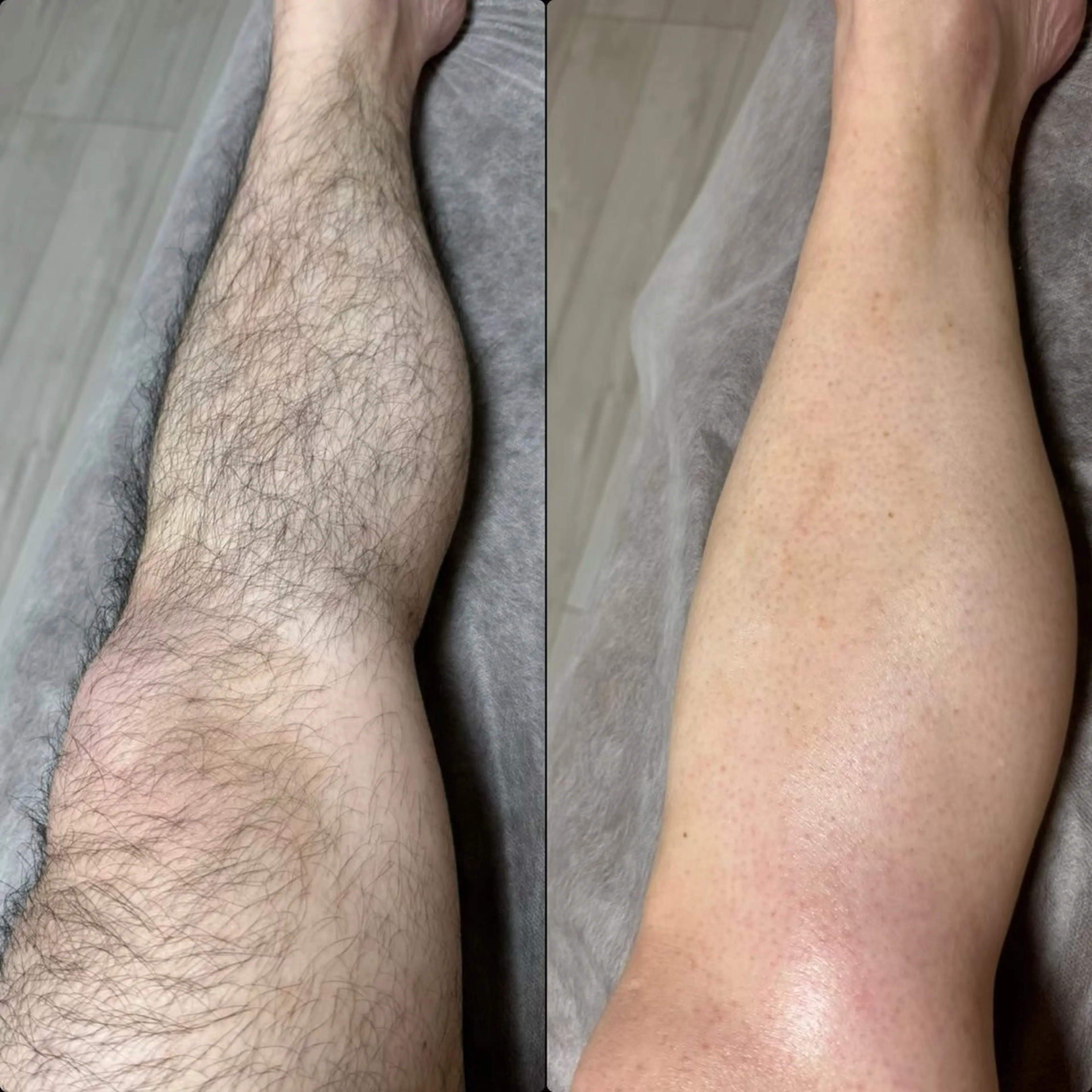 男性限定🉐足ワックス脱毛+光💡脱毛の写真