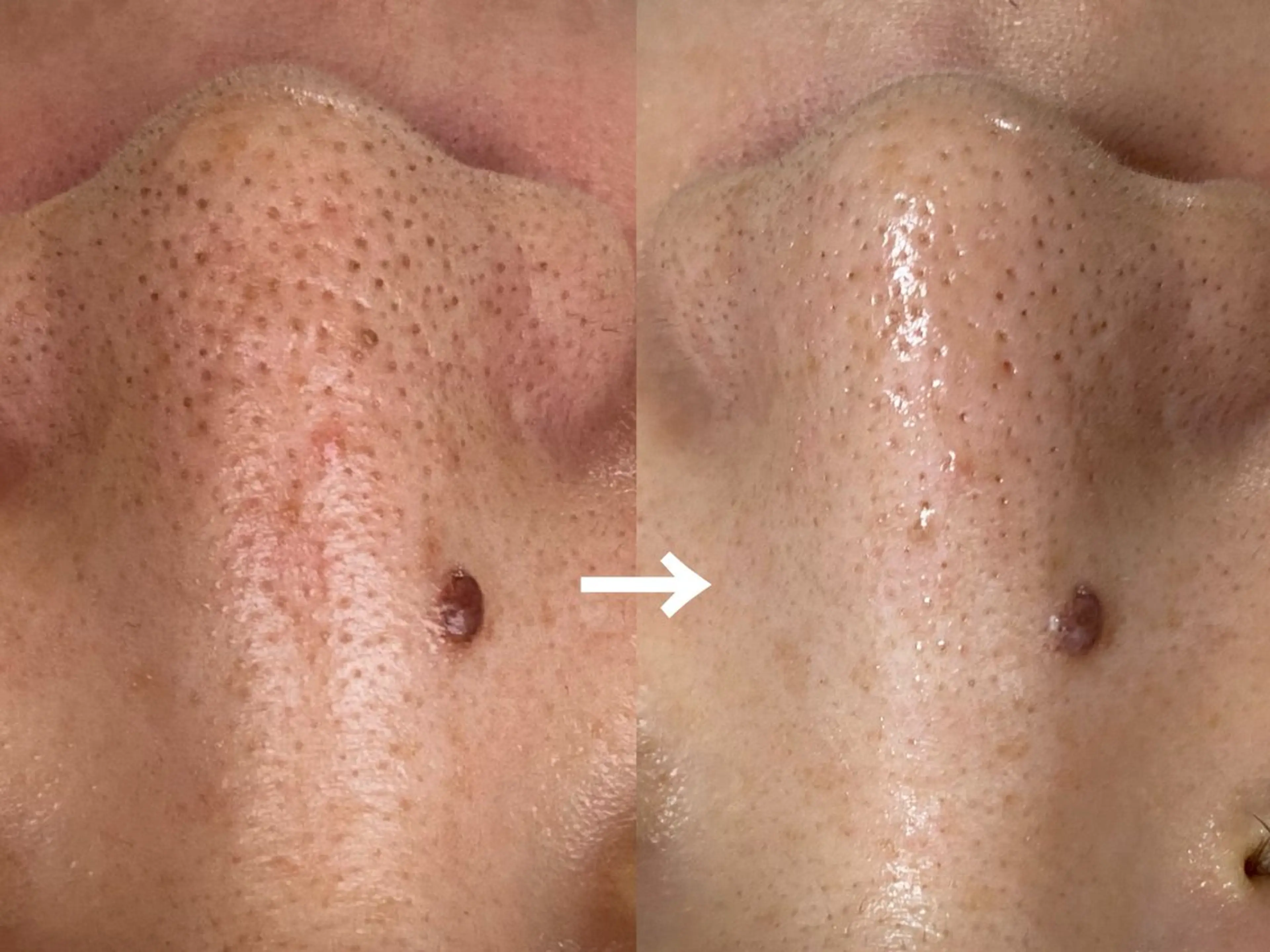 【ドバッと毛穴汚れ★小顔ケア付】角栓・黒ずみ・徹底毛穴洗浄！！の写真