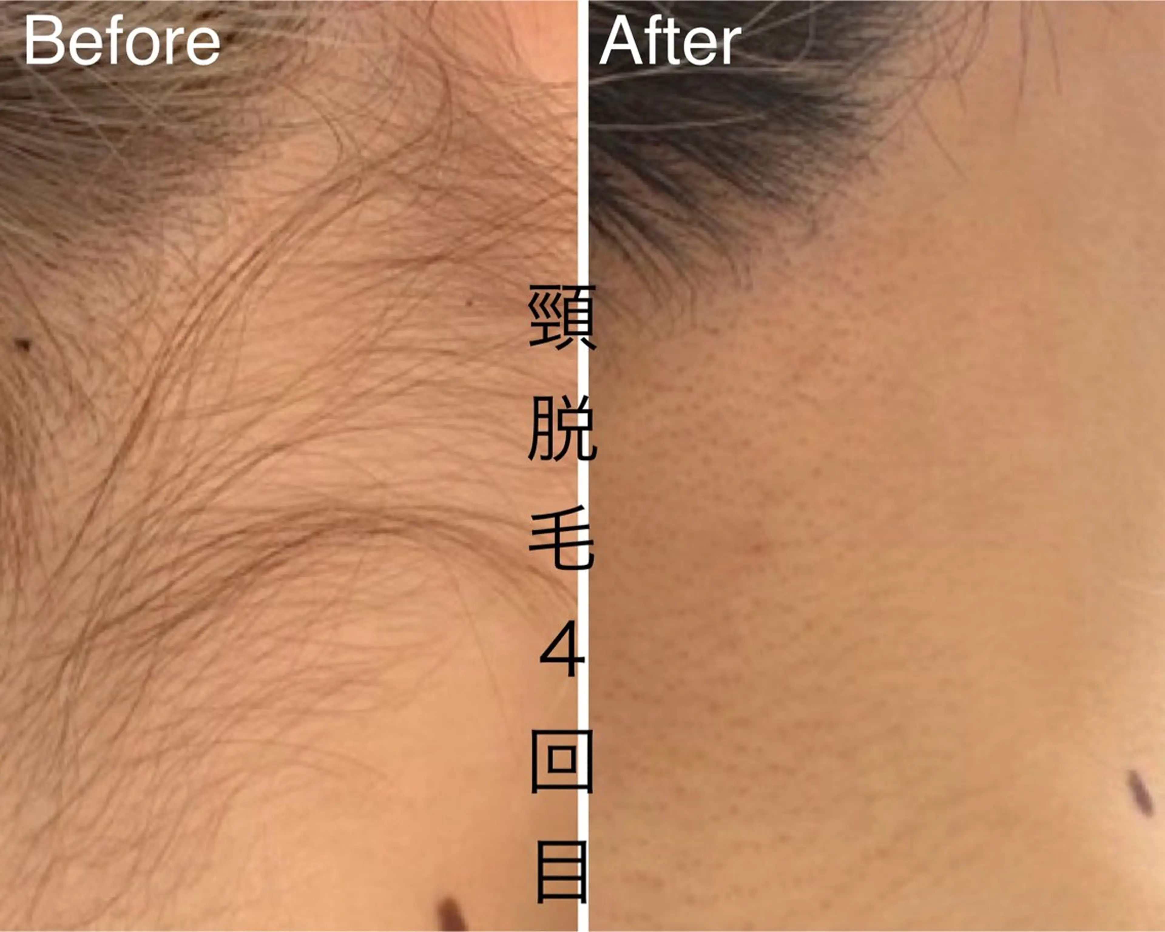 【女性限定/所要時間30分】★もみあげ～うなじ襟足脱毛★の写真