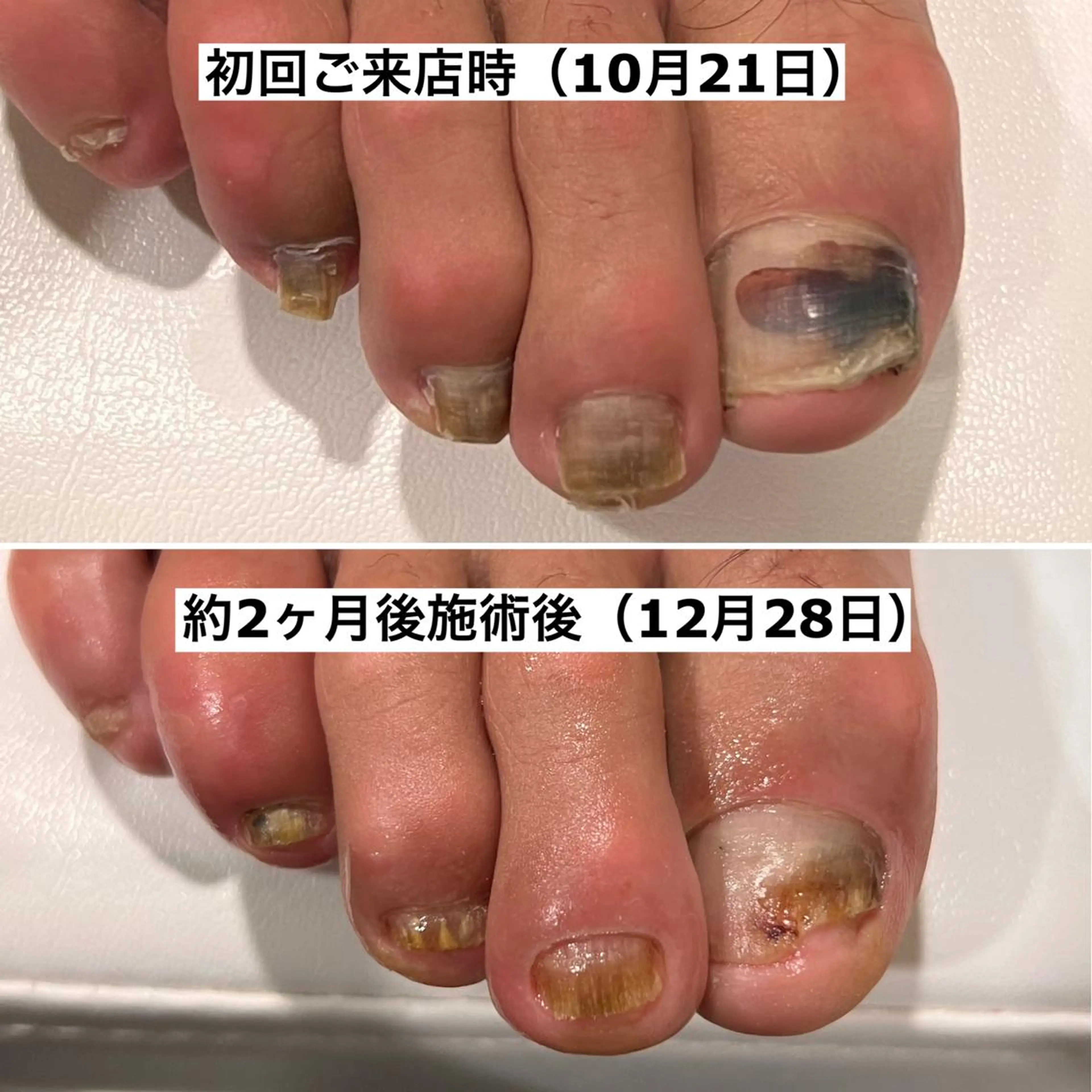 ネイル 巻爪無料モデル募集 ✨🦶MEGUMIのネイルデザイン