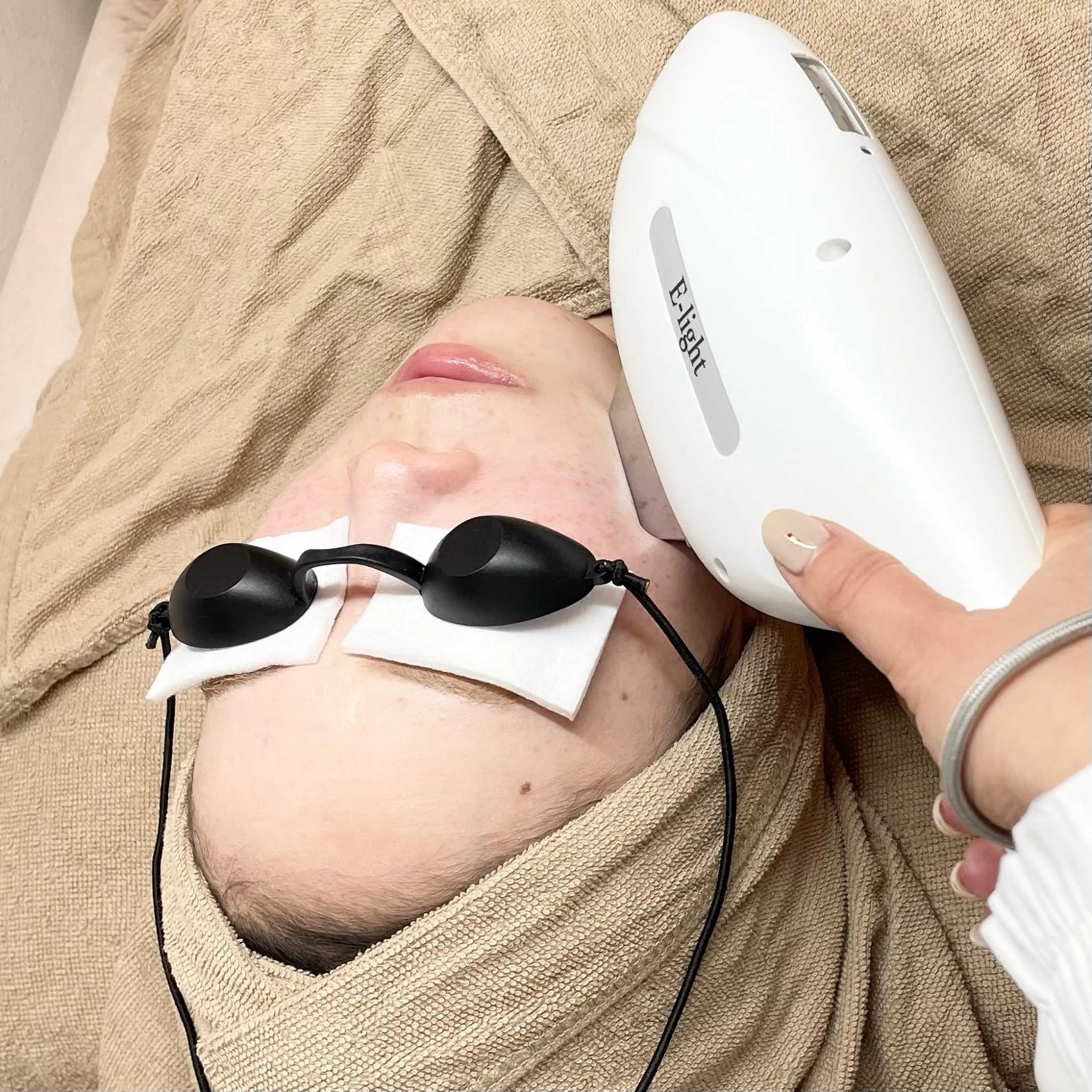 高濃度ビタミンC導入×最新フォトRFの写真