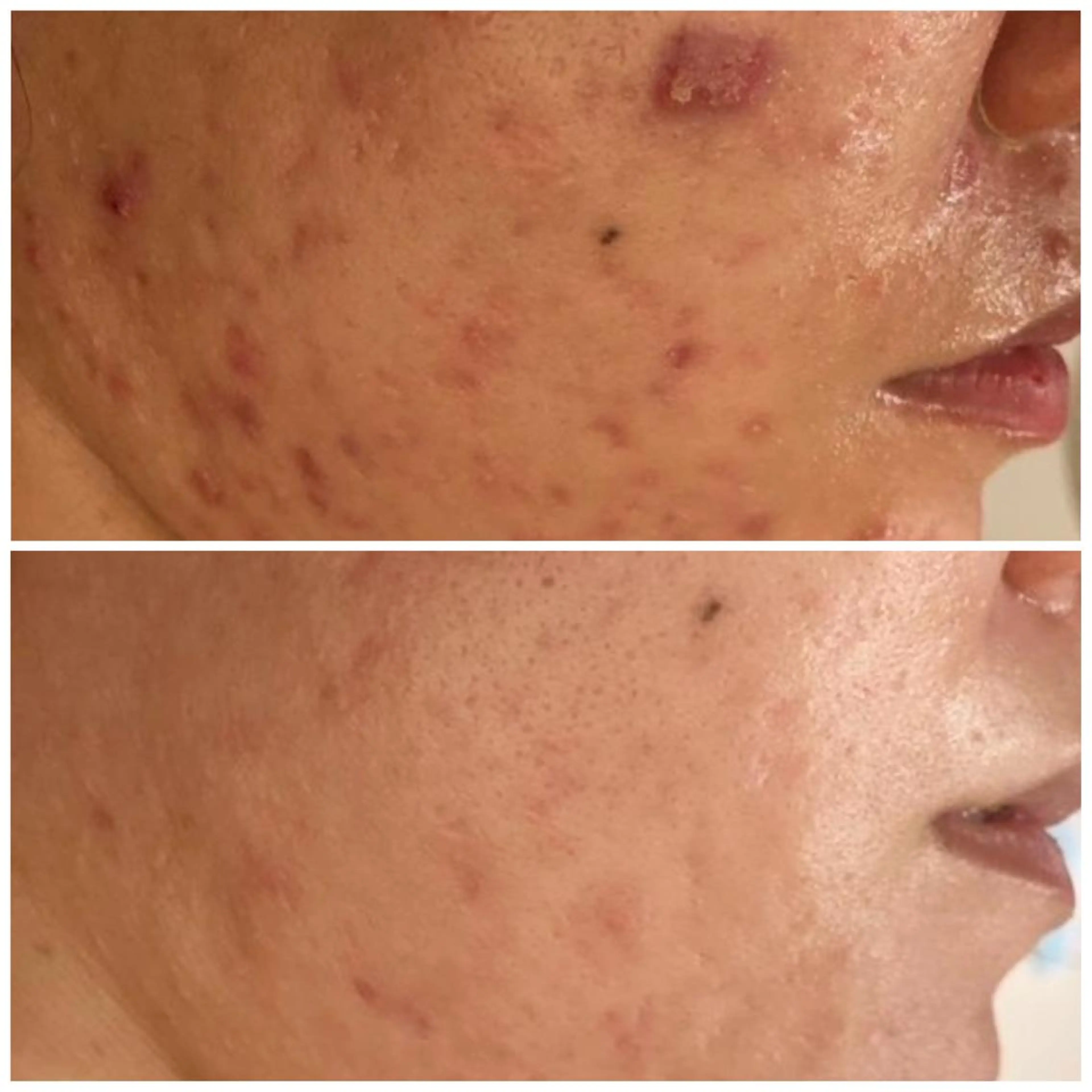 カラー パーマ ヘアアレンジ キッズ マツエク・マツパ アイブロウ エステ リラク 3か月で肌革命👼 ニキビ専門店💫のエステ・リラクイメージ