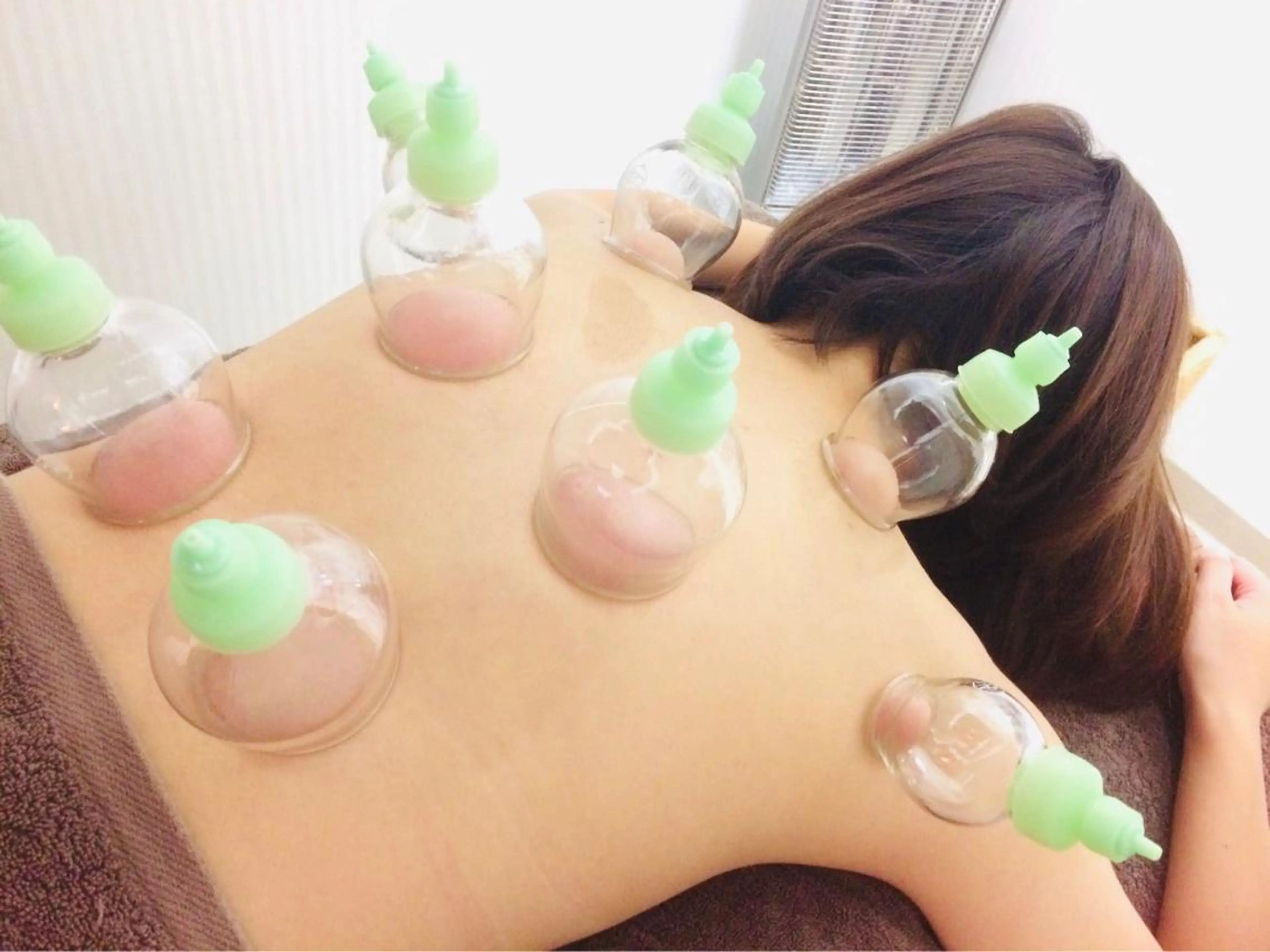 カッピング療法の写真