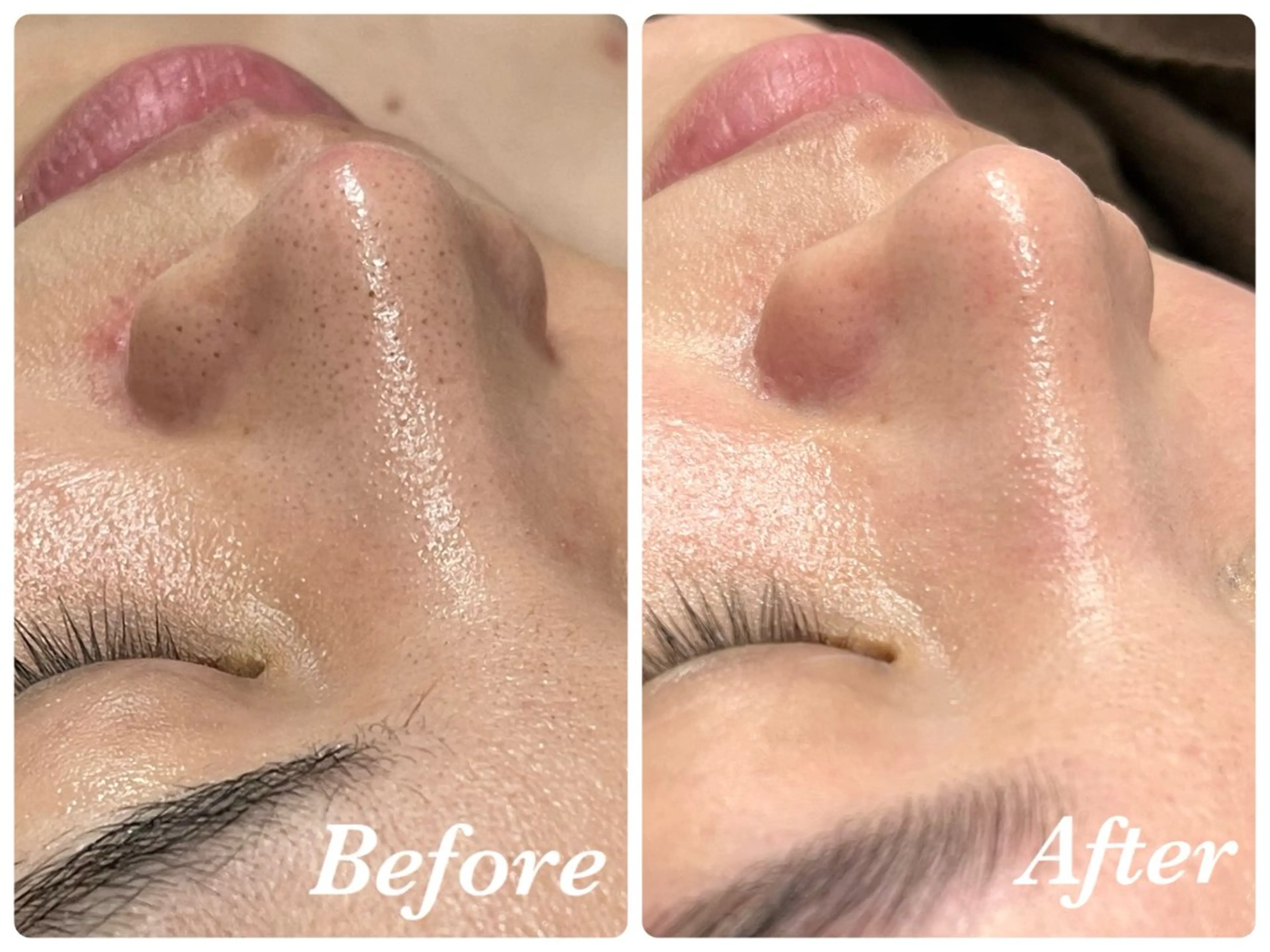 【いちご鼻黒ずみ撃退】鼻のみ★の写真