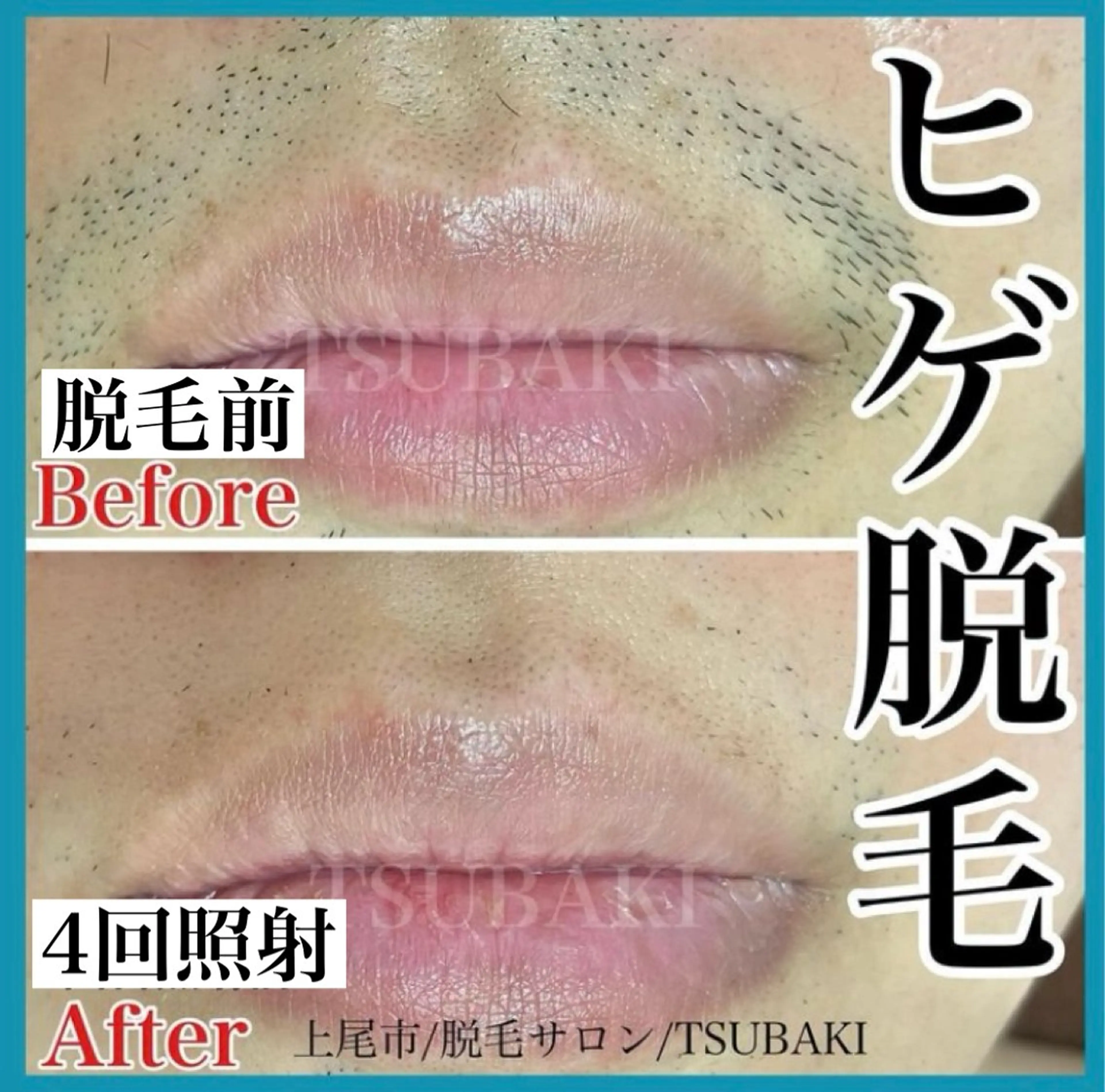 メンズ 脱毛 TSUBAKI上尾店所属・TSUBAKI上尾店 松下のエステ・リラクイメージ