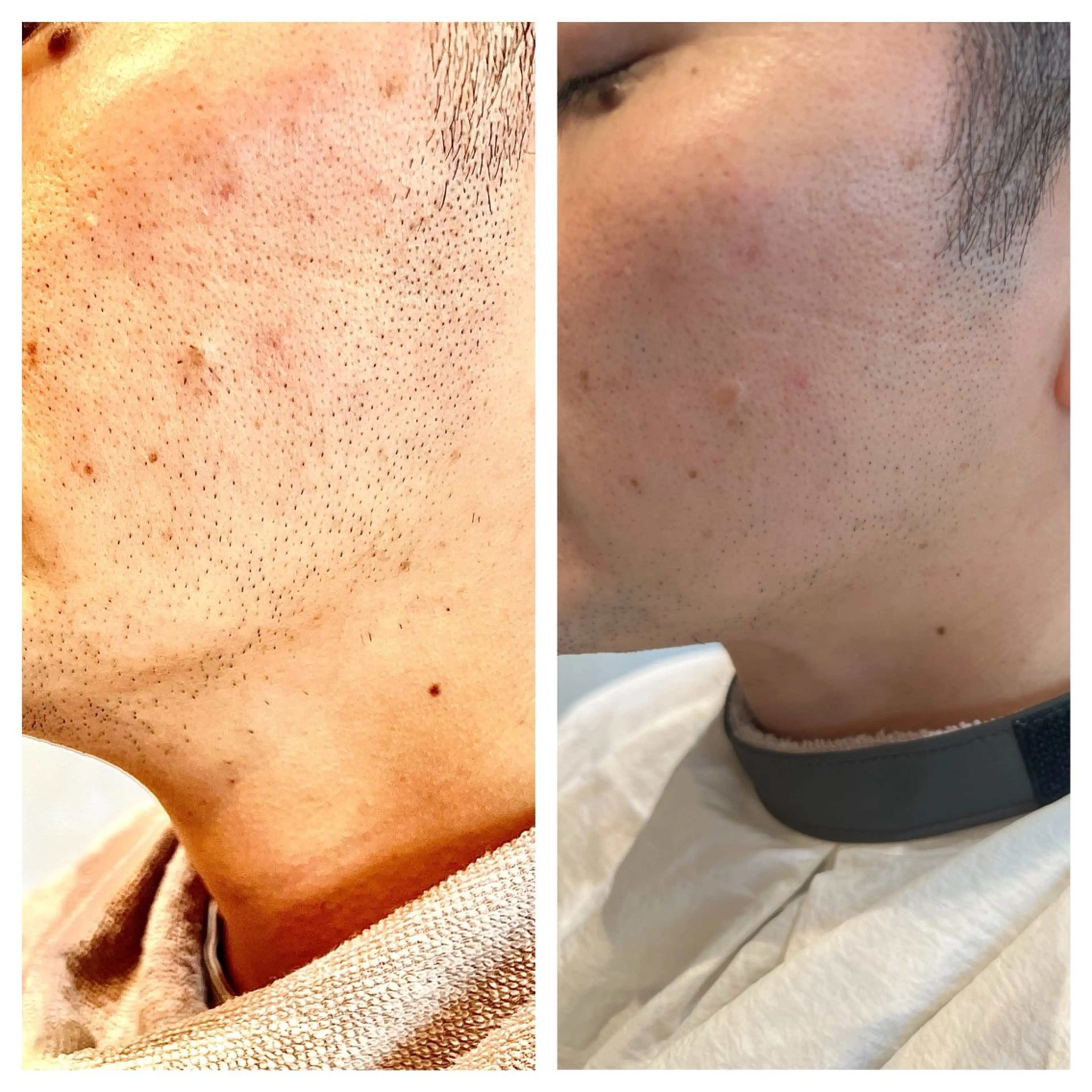 メンズひげ脱毛の写真