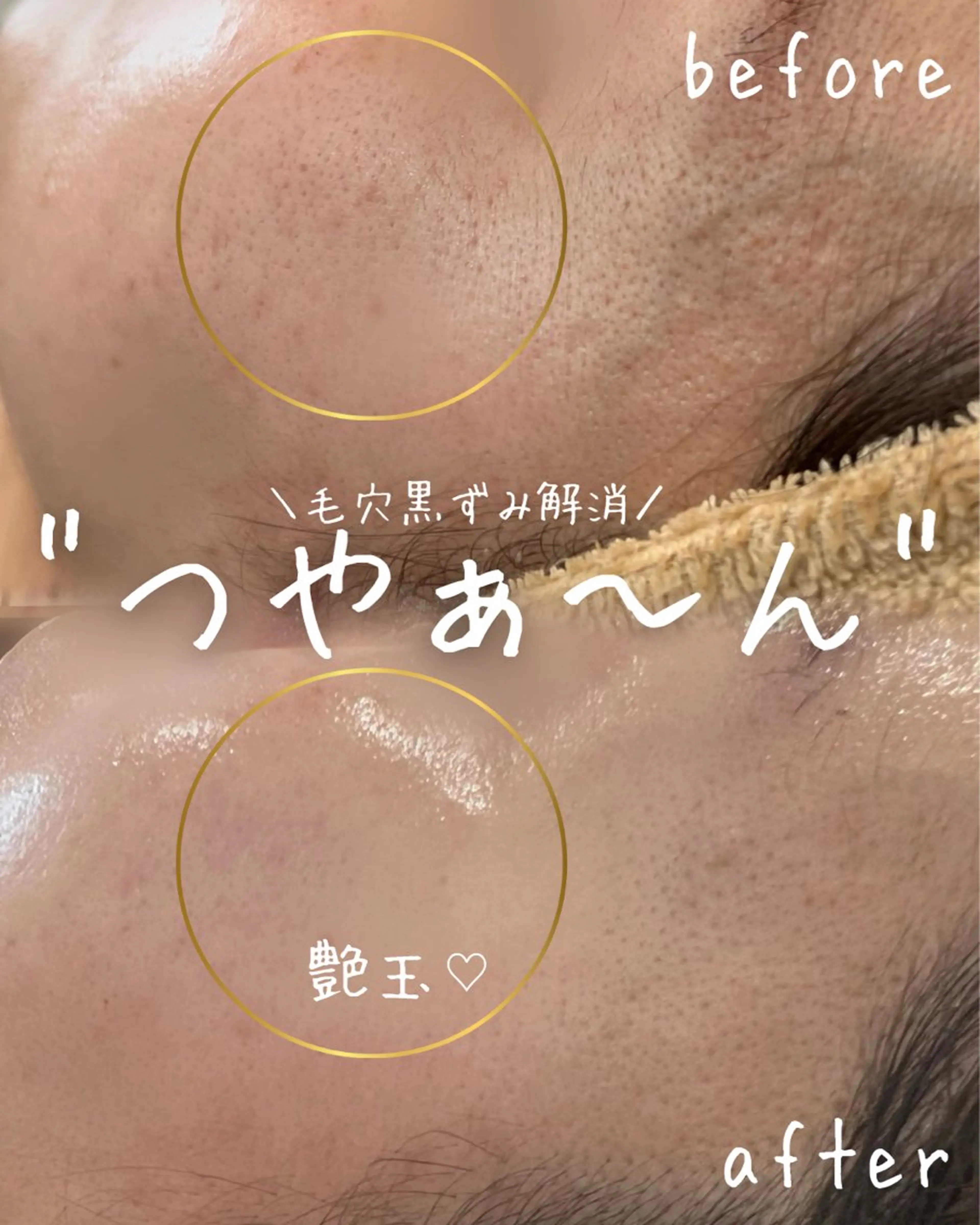 【初回】うるみ白玉トリートメント(美白・水光肌)の写真