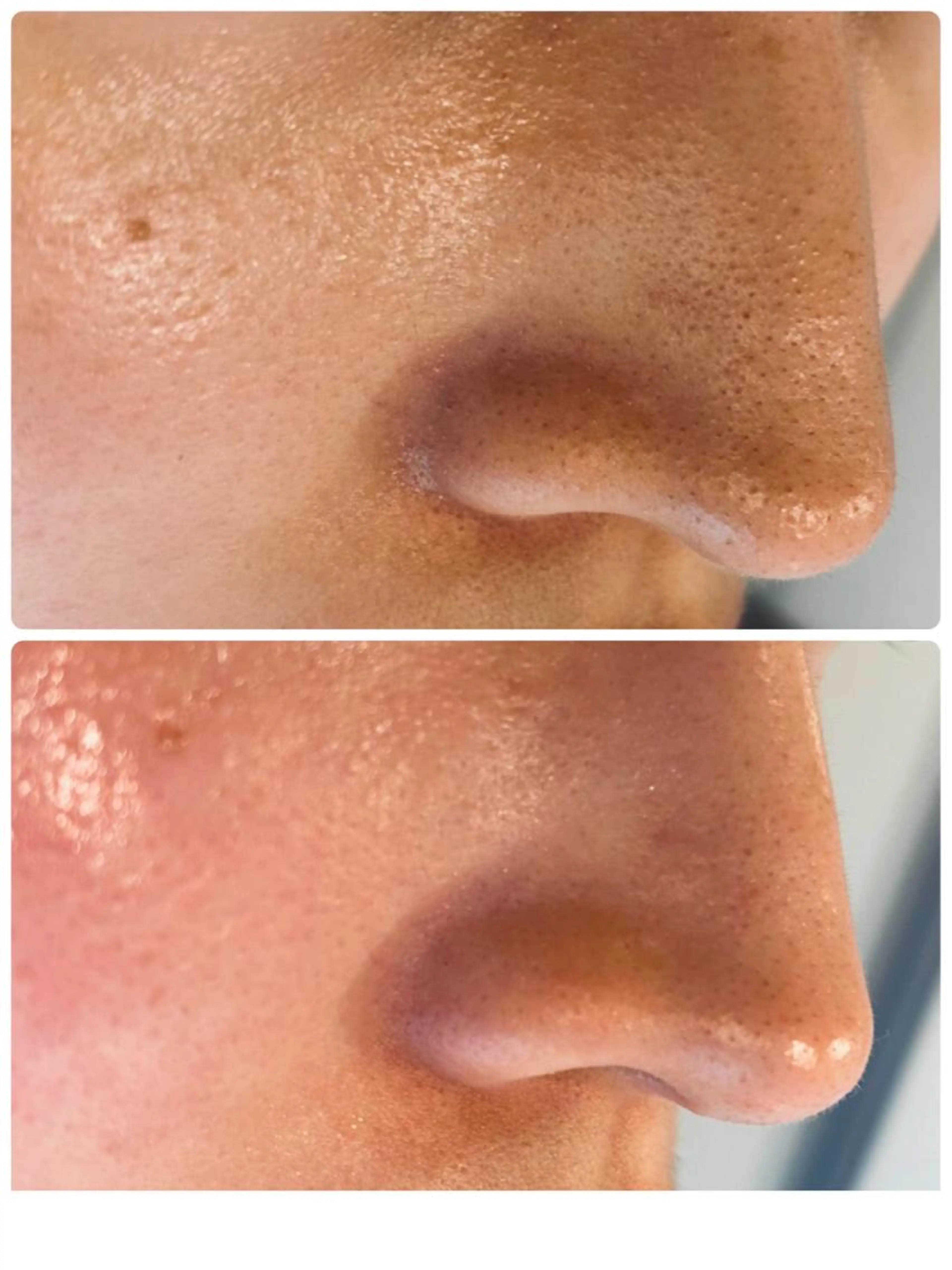 【毛穴洗浄】ピーリング角栓黒ずみ除去！ハイドラ＆美容液導入エレクトロポレーション60分💎✨￥22000→の写真