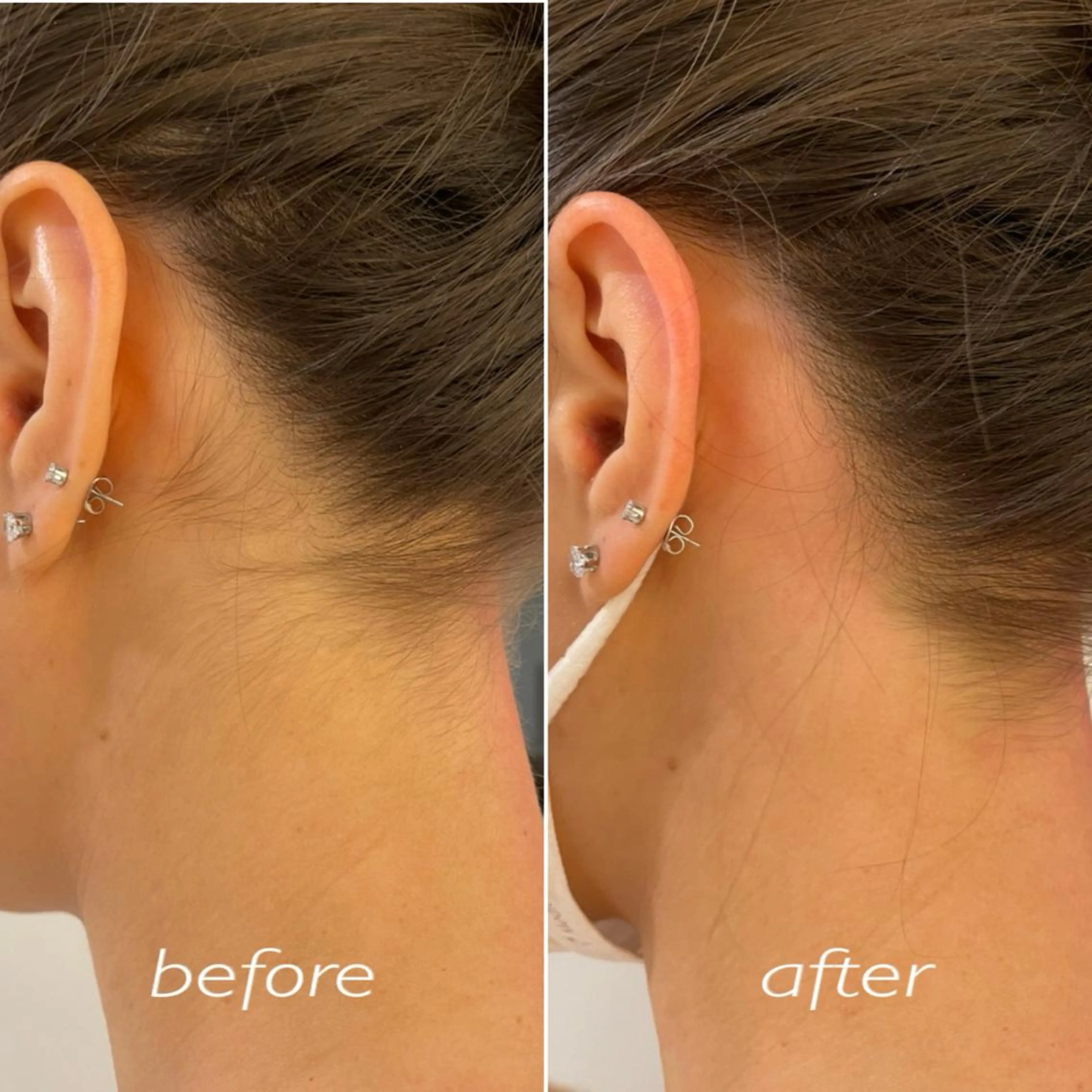 うなじ シュガーリングの写真