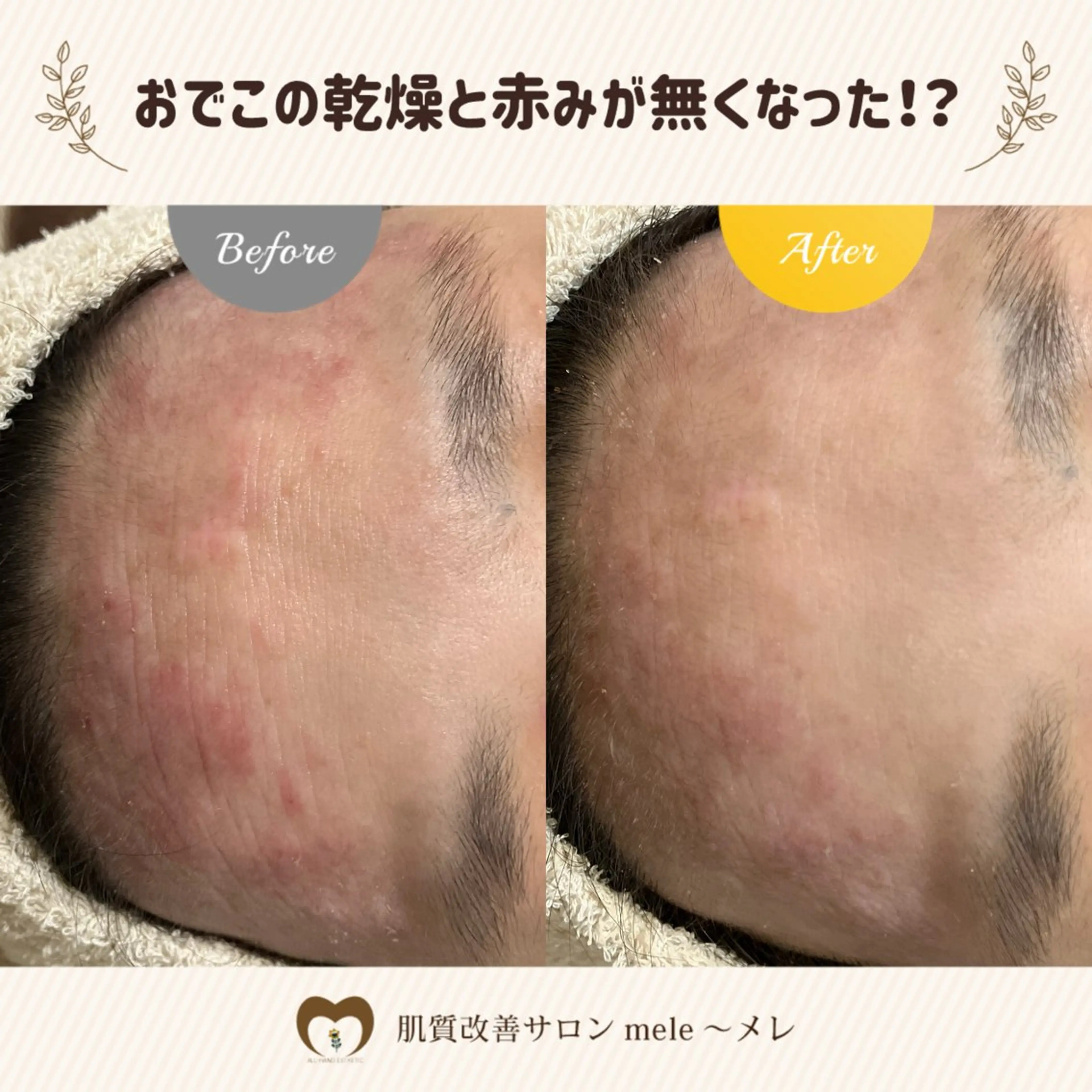 繰り返すニキビ・毛穴 ✨つくば肌質改善専門のエステ・リラクイメージ