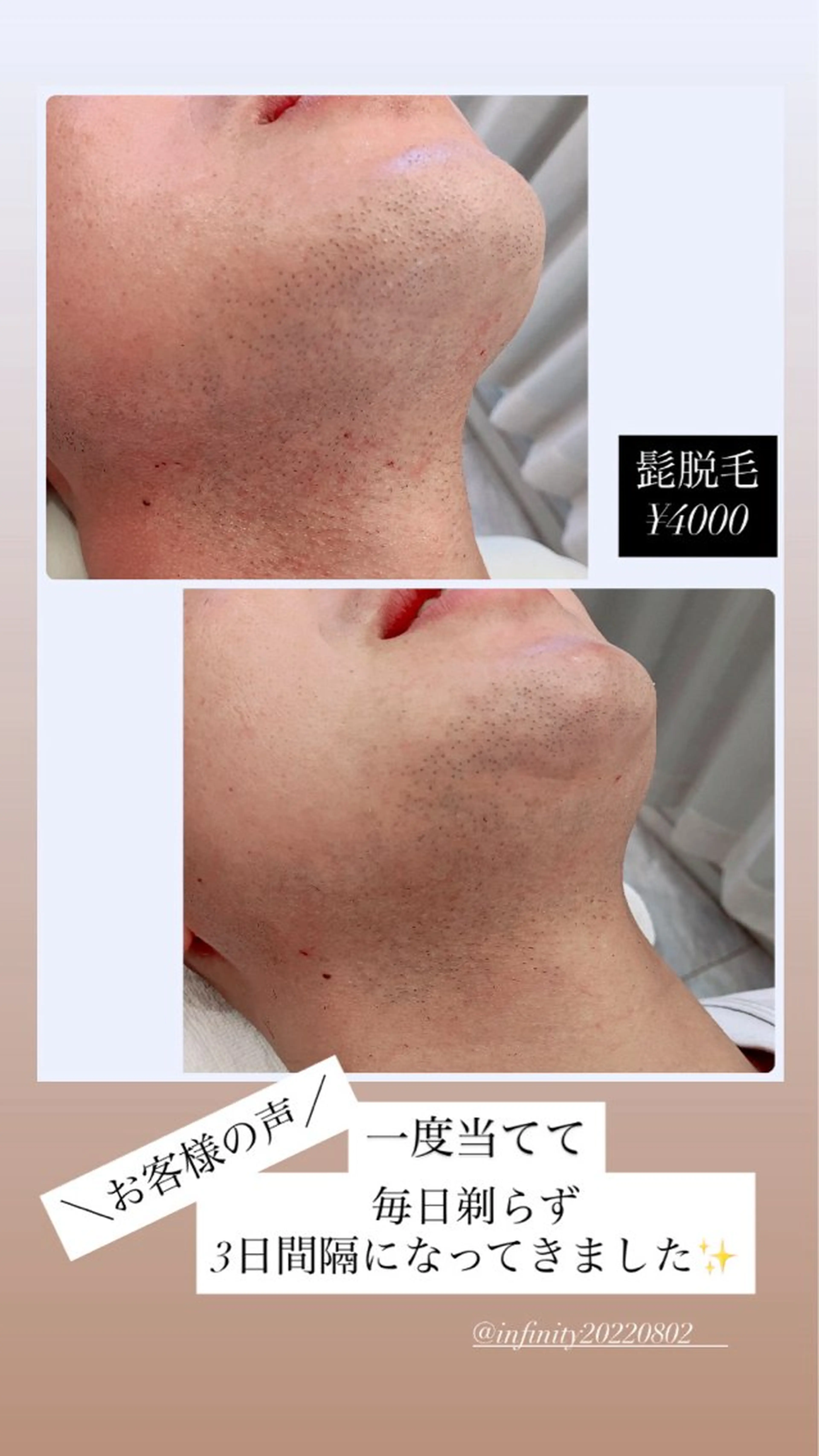 脱毛 infinity所属・Infinity KAYOのその他イメージ