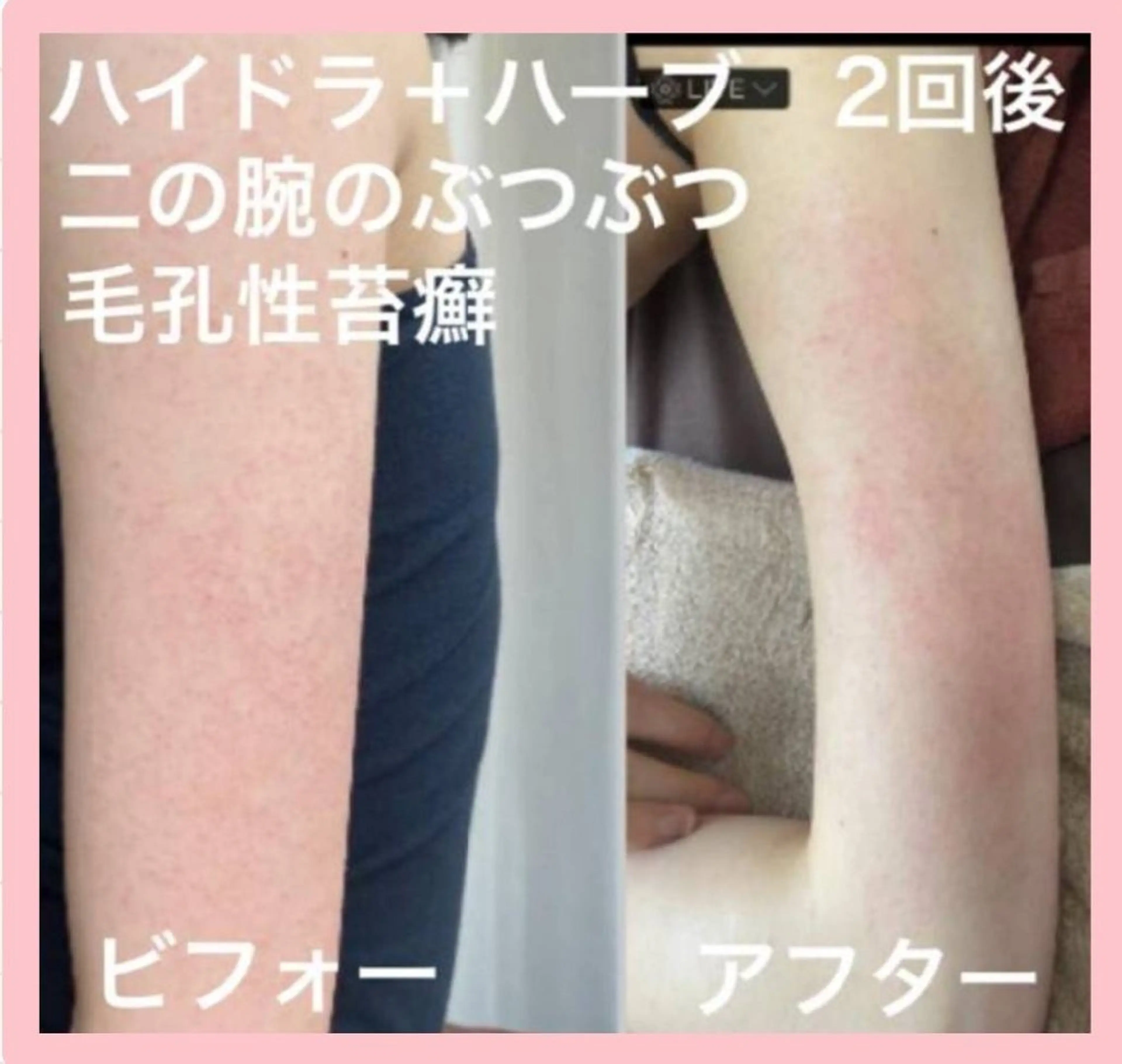 🌿Bodyハーブピーリング＆美容洗浄🌿(剥離あり)背中、腰、二の腕、お尻、デコルテ等🩵吹き出物、吹き出物跡、色跡にの写真