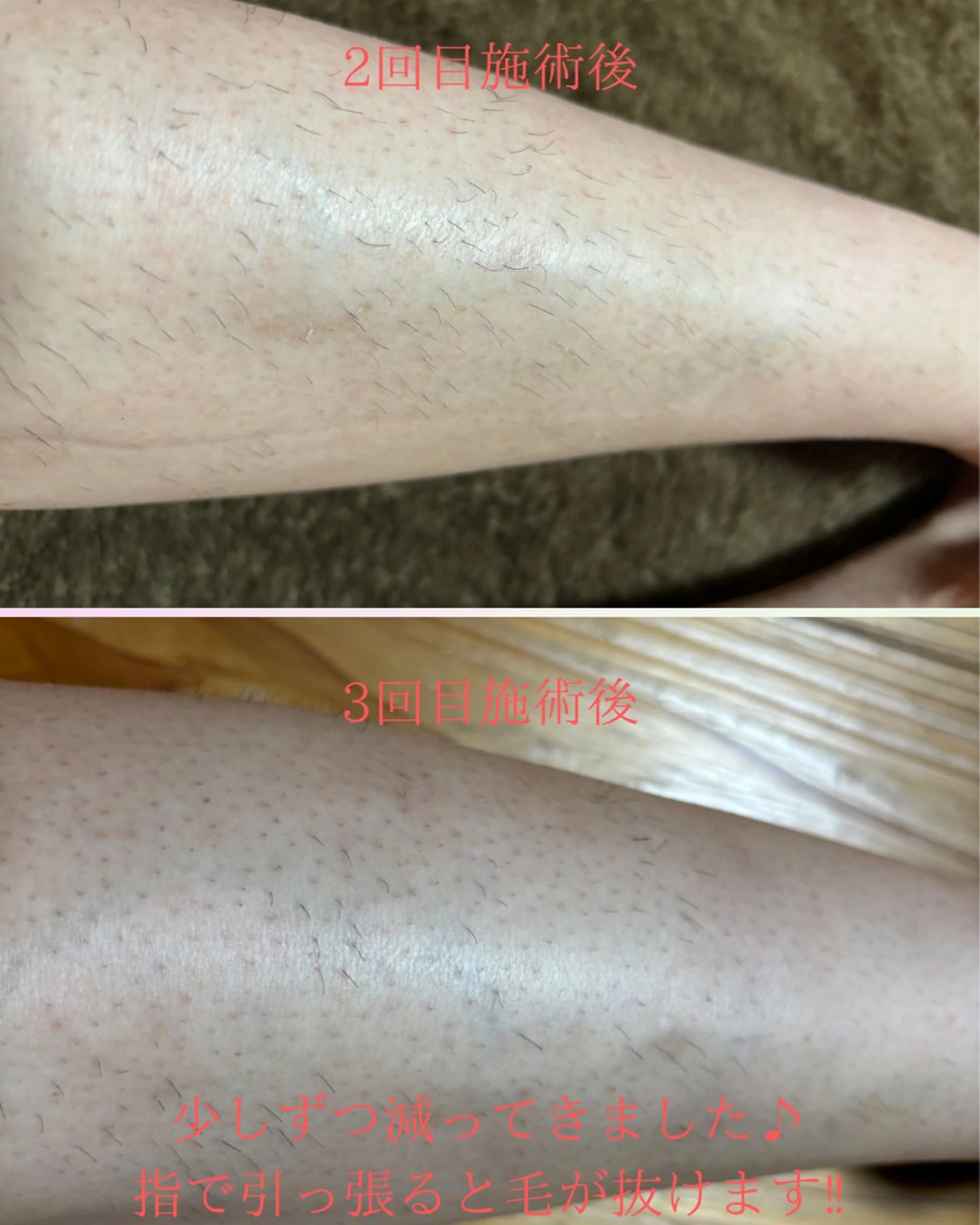 ◆メンズ脚まるごとチクチクしないサラッと肌にの写真