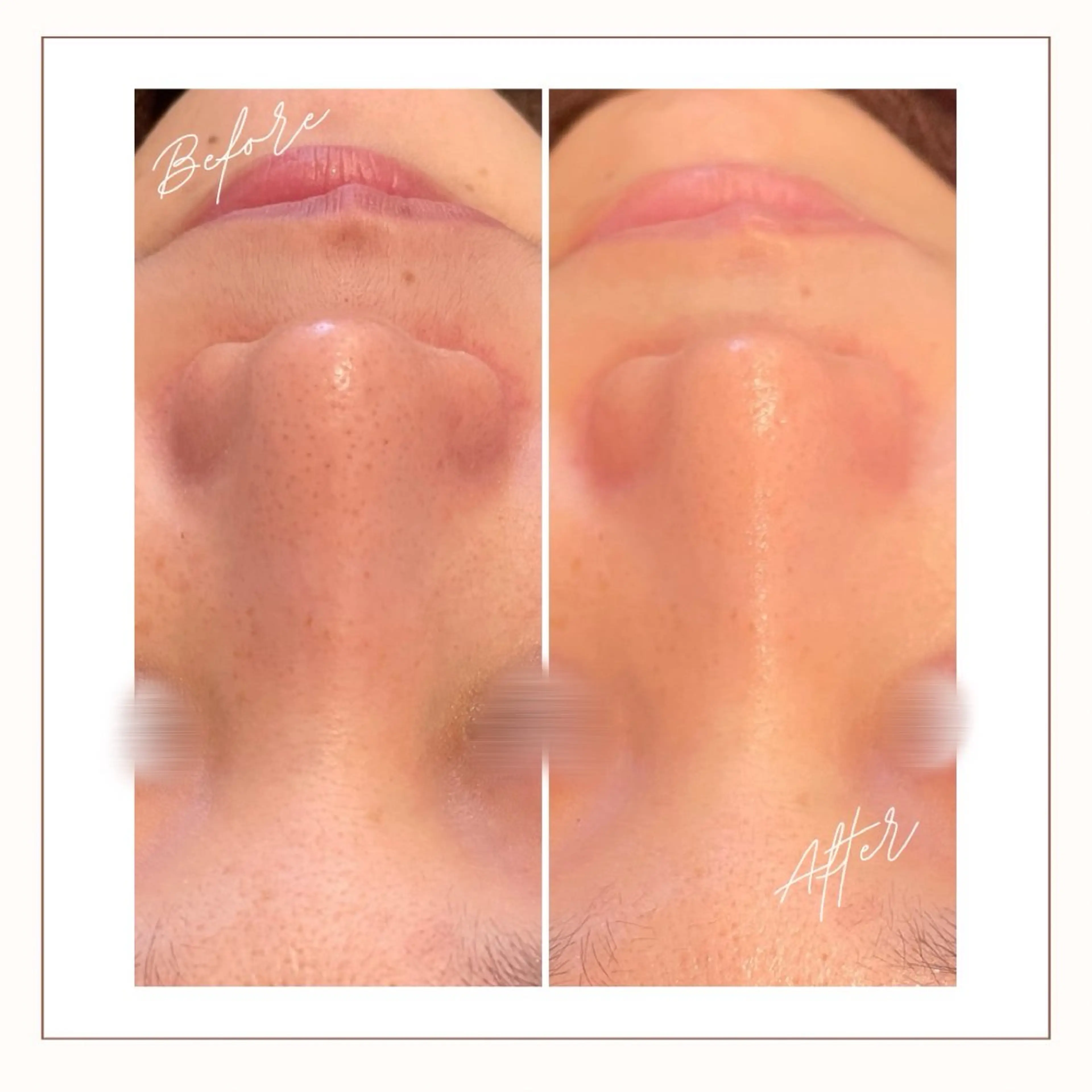 エステ AY'S所属・倉敷/玉島/20代 からの大人毛穴洗浄のエステ・リラクイメージ