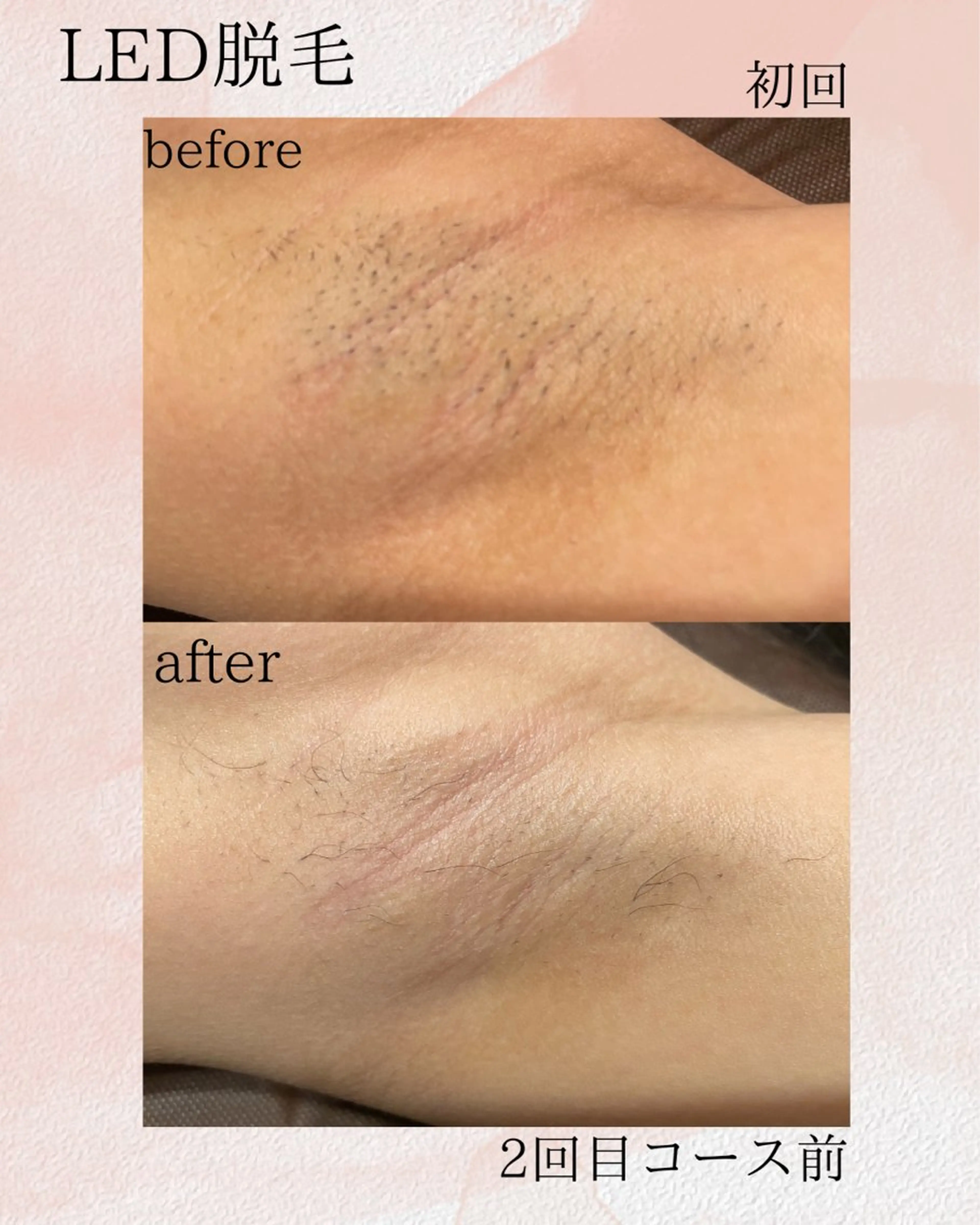 脱毛 KA PILINAのエステ・リラクイメージ