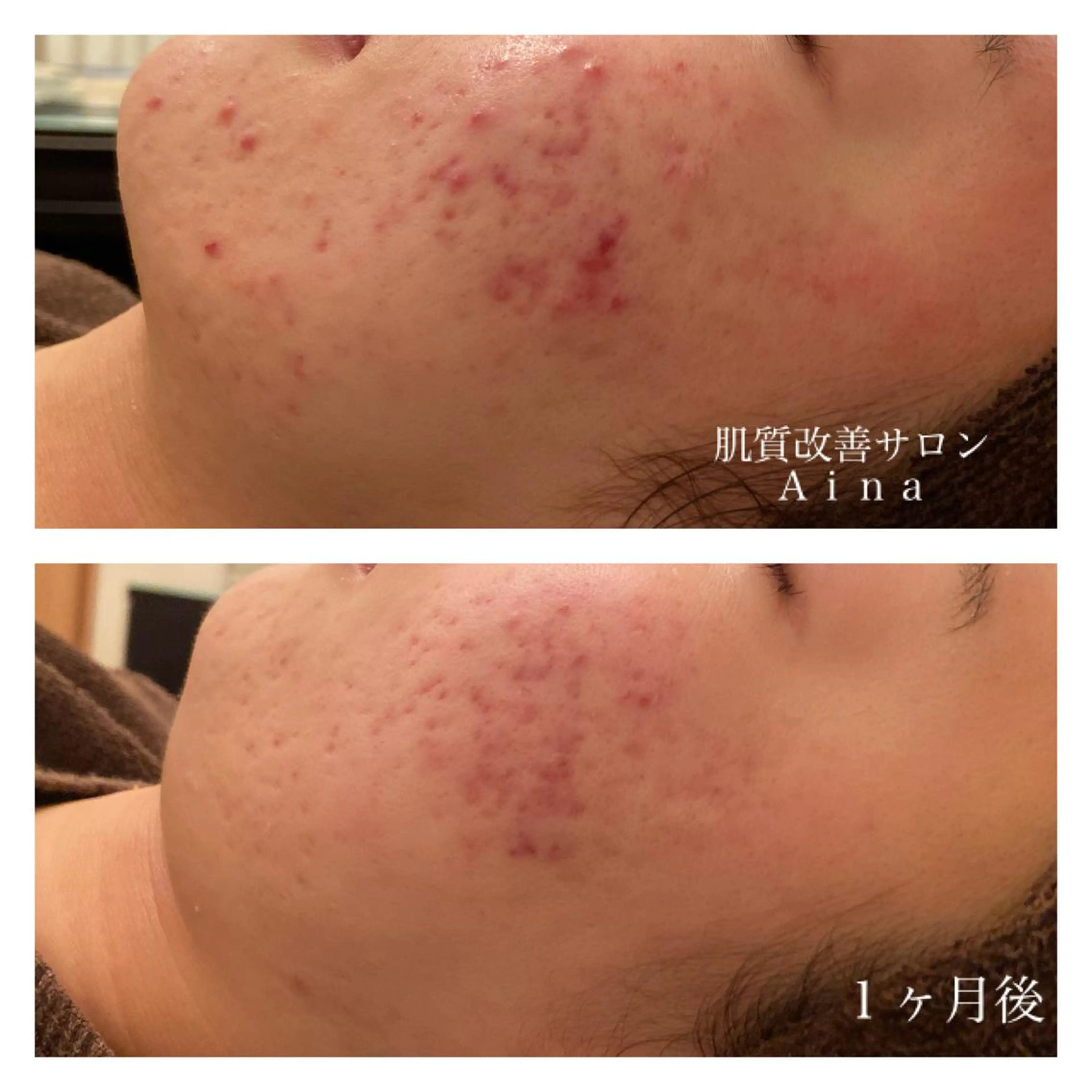 ミディアム カラー パーマ ヘアアレンジ メンズ キッズ ネイル マツエク・マツパ 卒業式のヘアスタイル 卒業式 赤色 エステ リラク ニキビ跡専門サロン Ａｉｎａのエステ・リラクイメージ