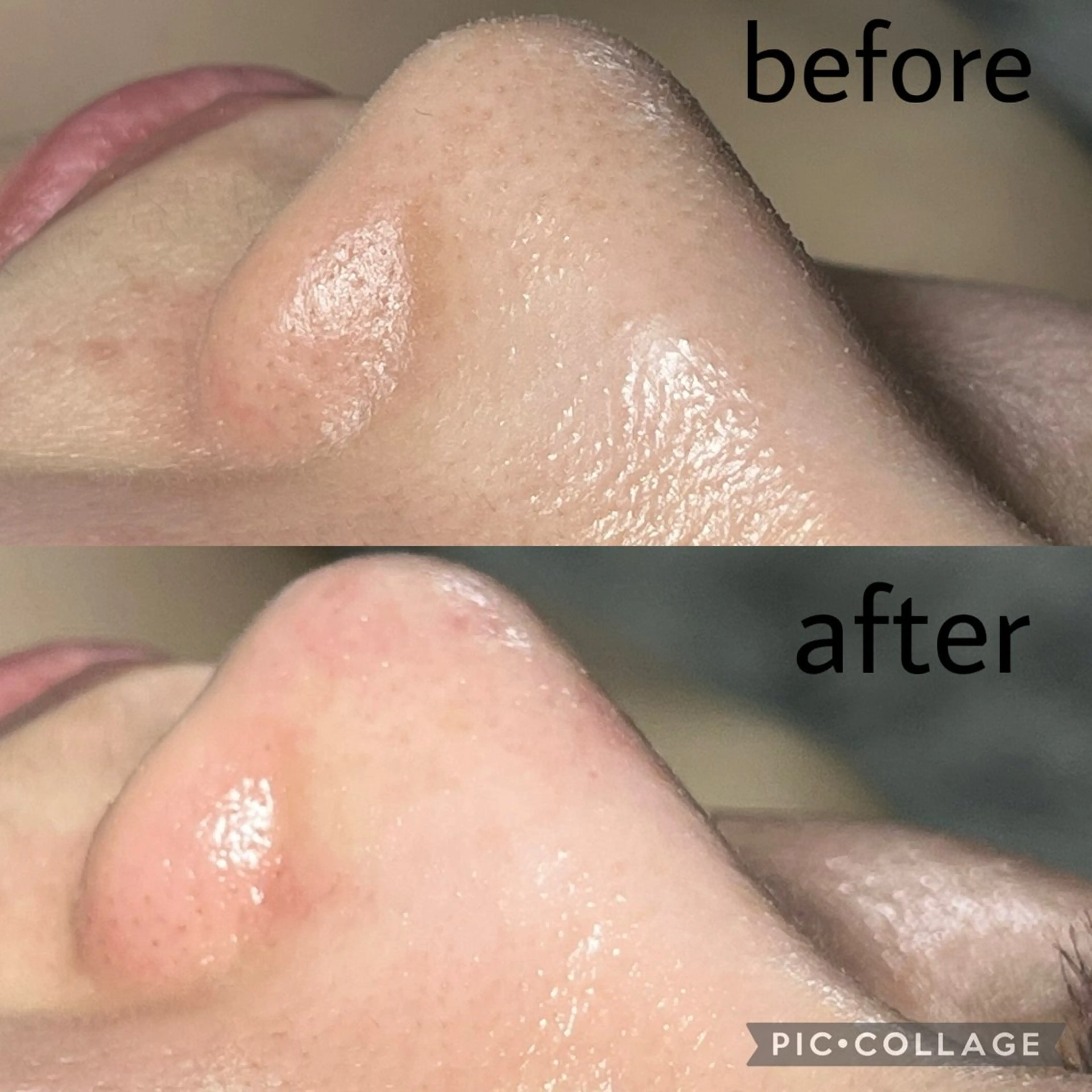 【鼻の黒ずみ改善】毛穴洗浄フェイシャル➕首肩デコルテリンパマッサージ付の写真