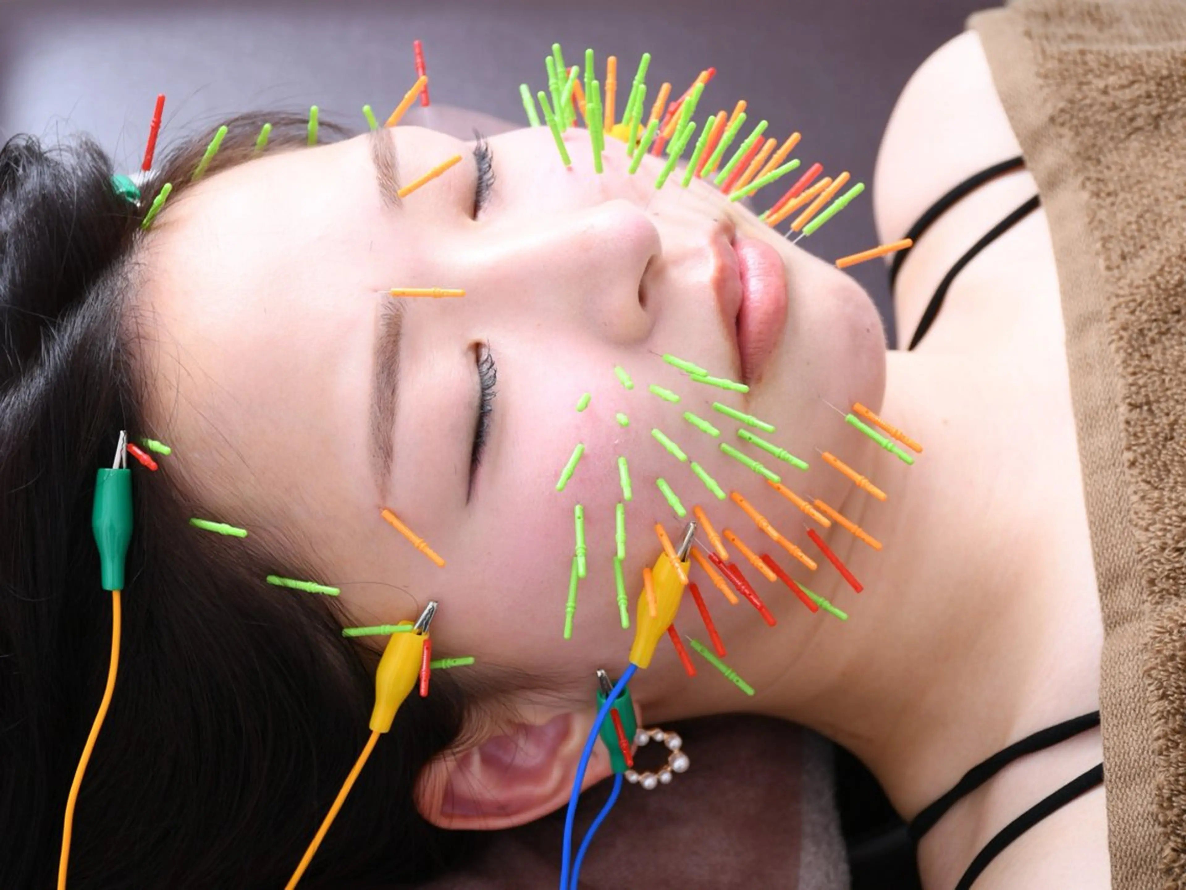 【人気No.1】即効果を実感💕🌸百華鍼（ﾋｬｯｶｼﾝ）🌸100本の美容鍼＋小顔矯正＋猫背矯正の写真