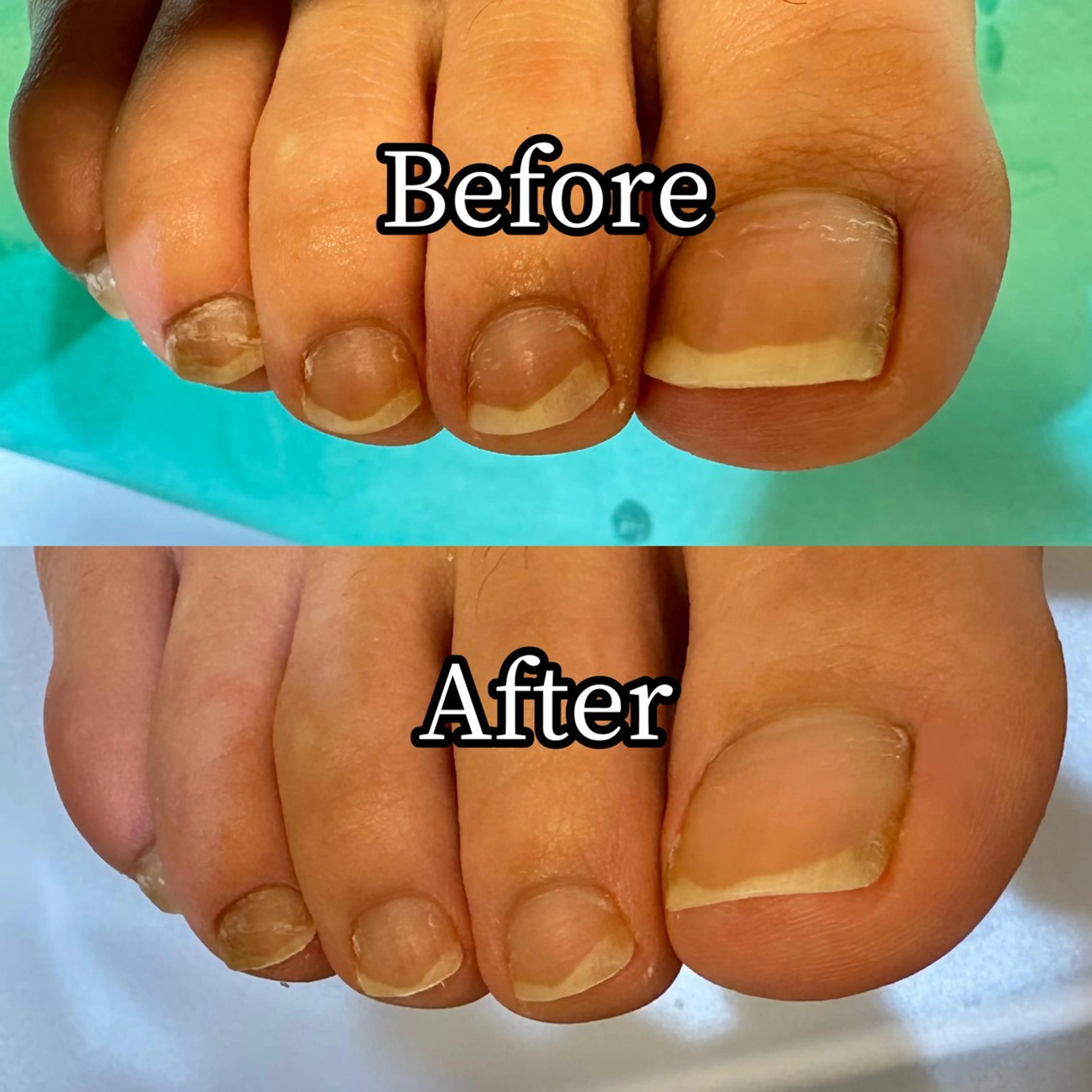 ネイル その他 巻き爪補正店 横浜関内店のネイルデザイン