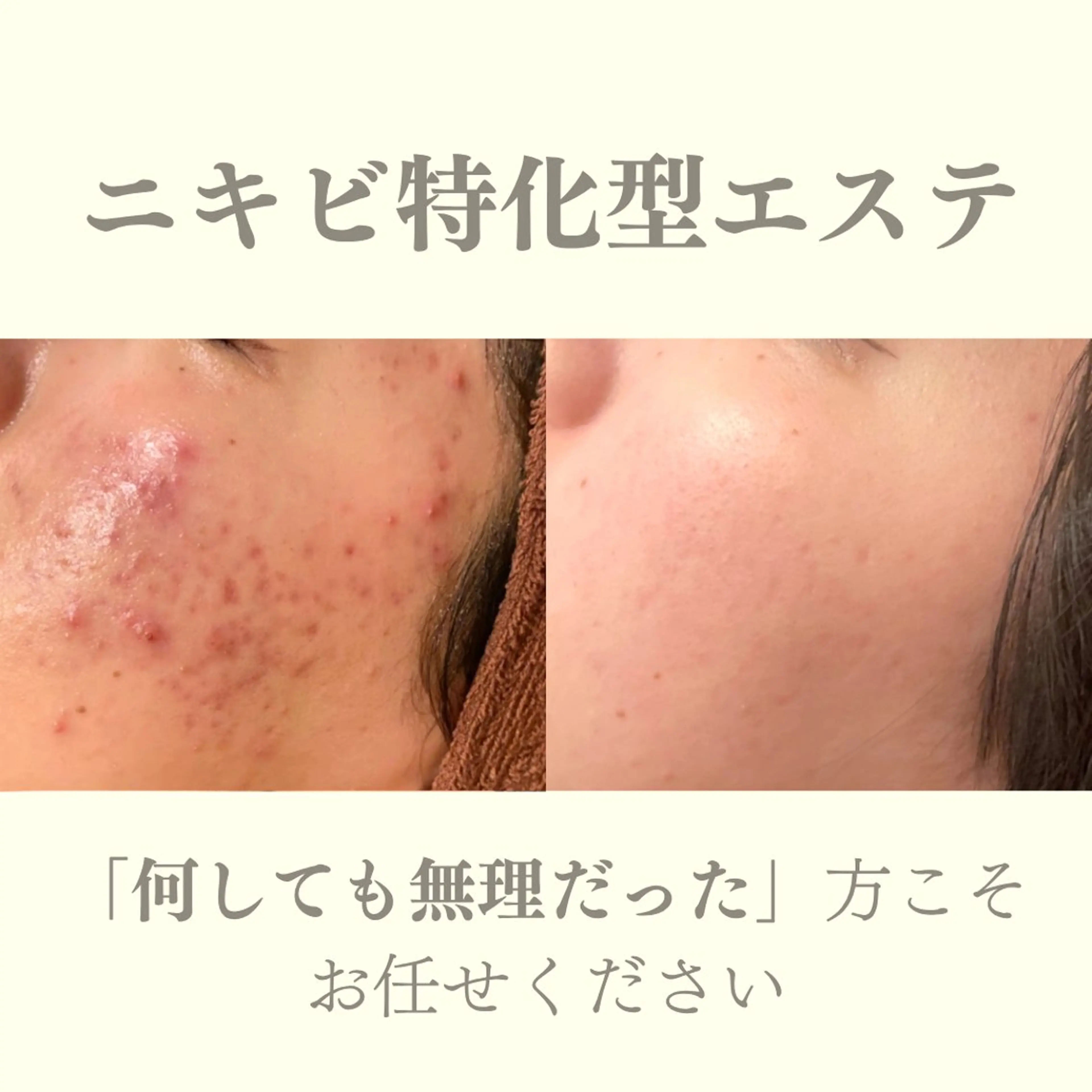 エステ リラク ニキビ特化型エステ 🍋最短で肌質改善のエステ・リラクイメージ