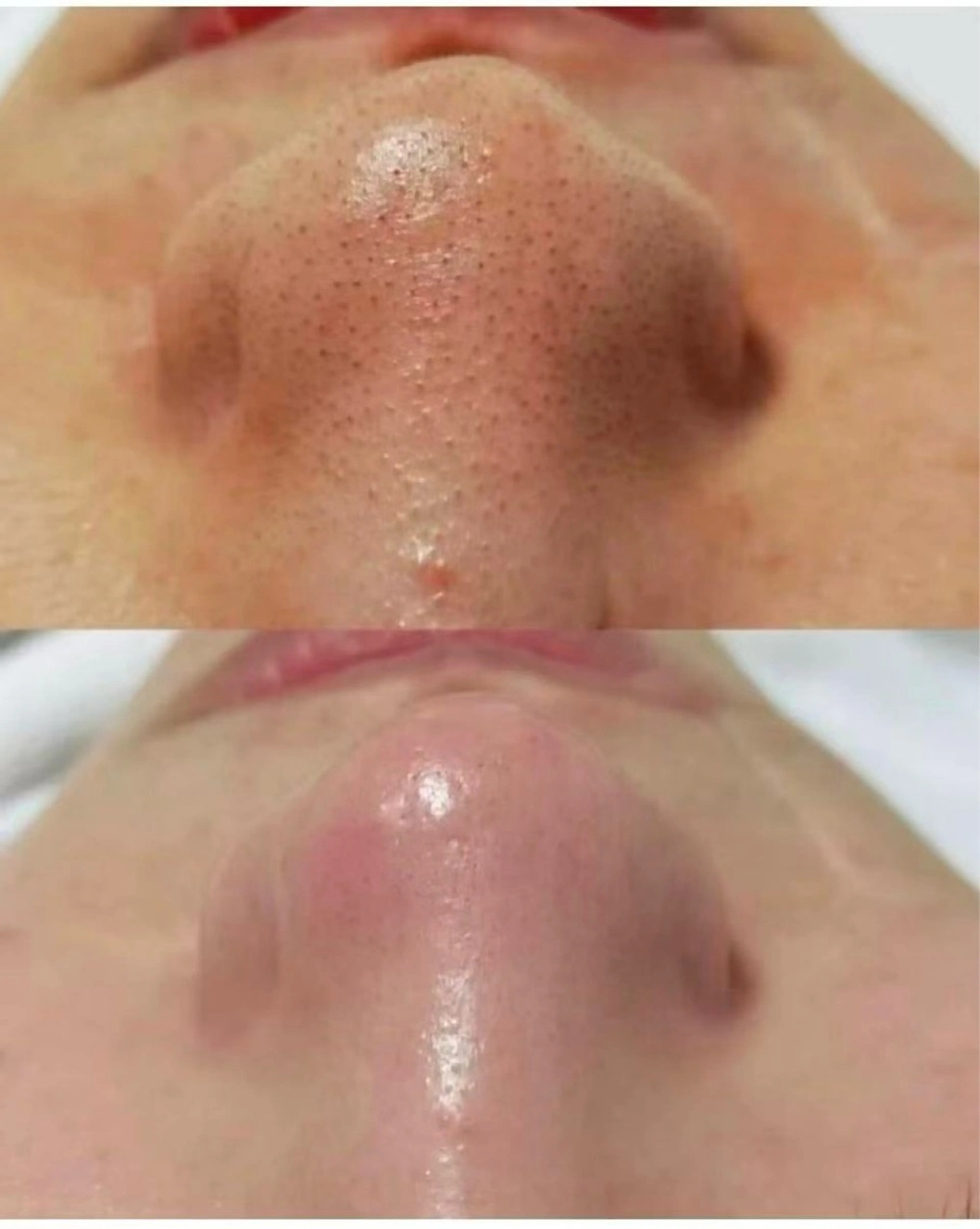 【黒ずみ毛穴/ニキビケア/角質除去】毛穴掃除コース➕医療パックの写真