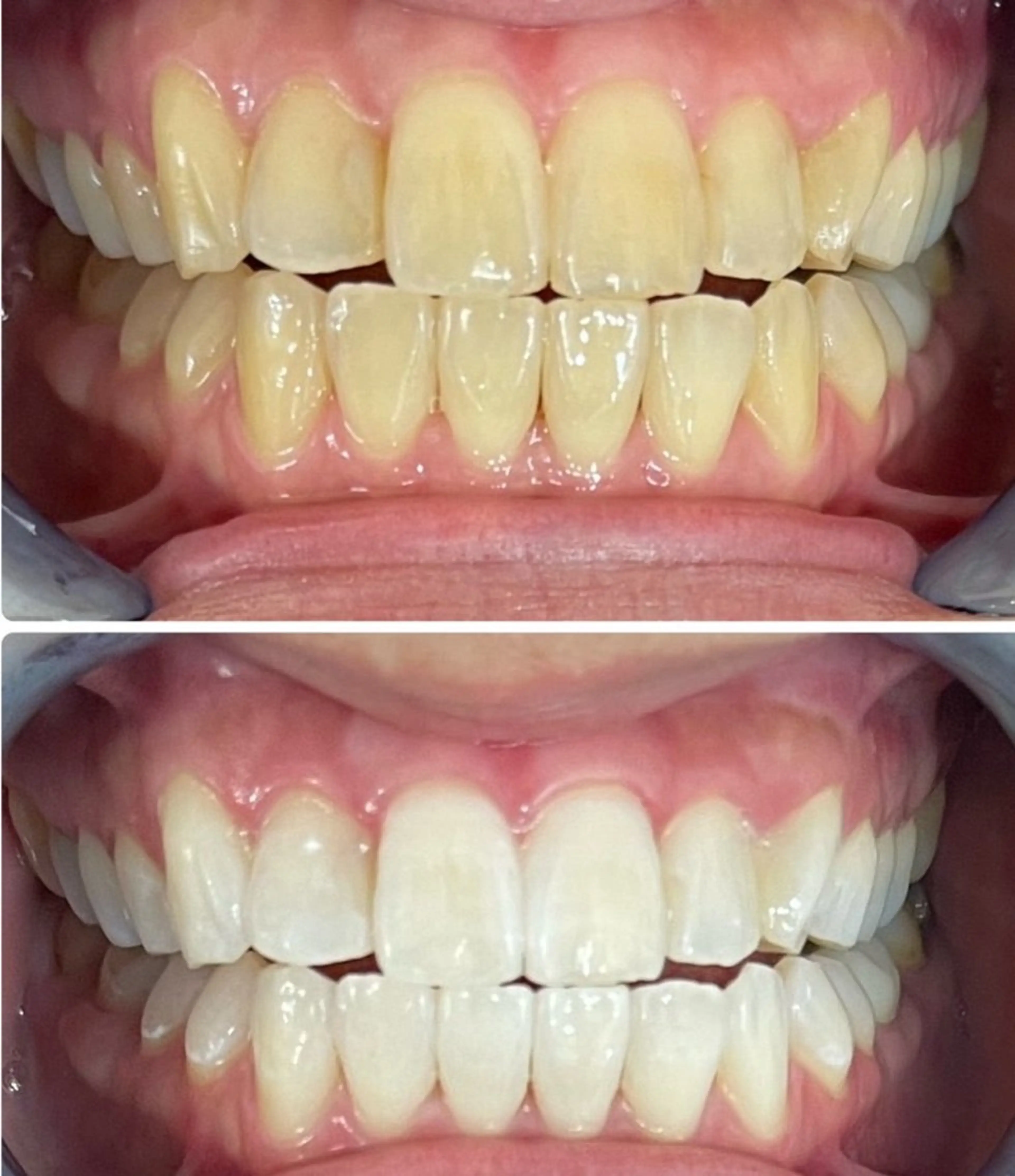 【歯科提携ホワイトニング】!30分4980円で歯科ホワイトニングを体験!の写真