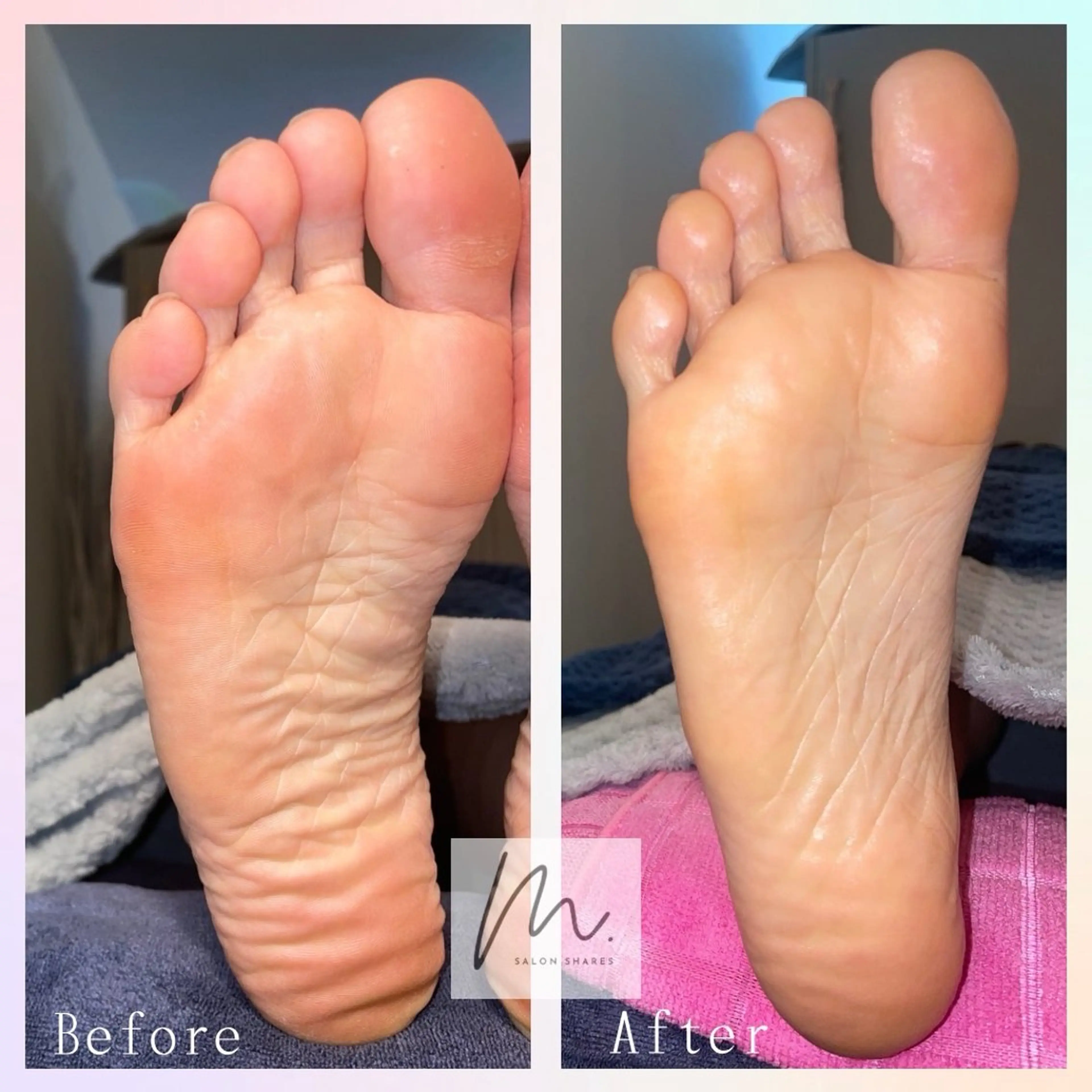 期間限定⛄️セルライトケア上半身痩身+フットカウンセリングモデル募集中0円！！！！写真口コミ必須📸📝の写真