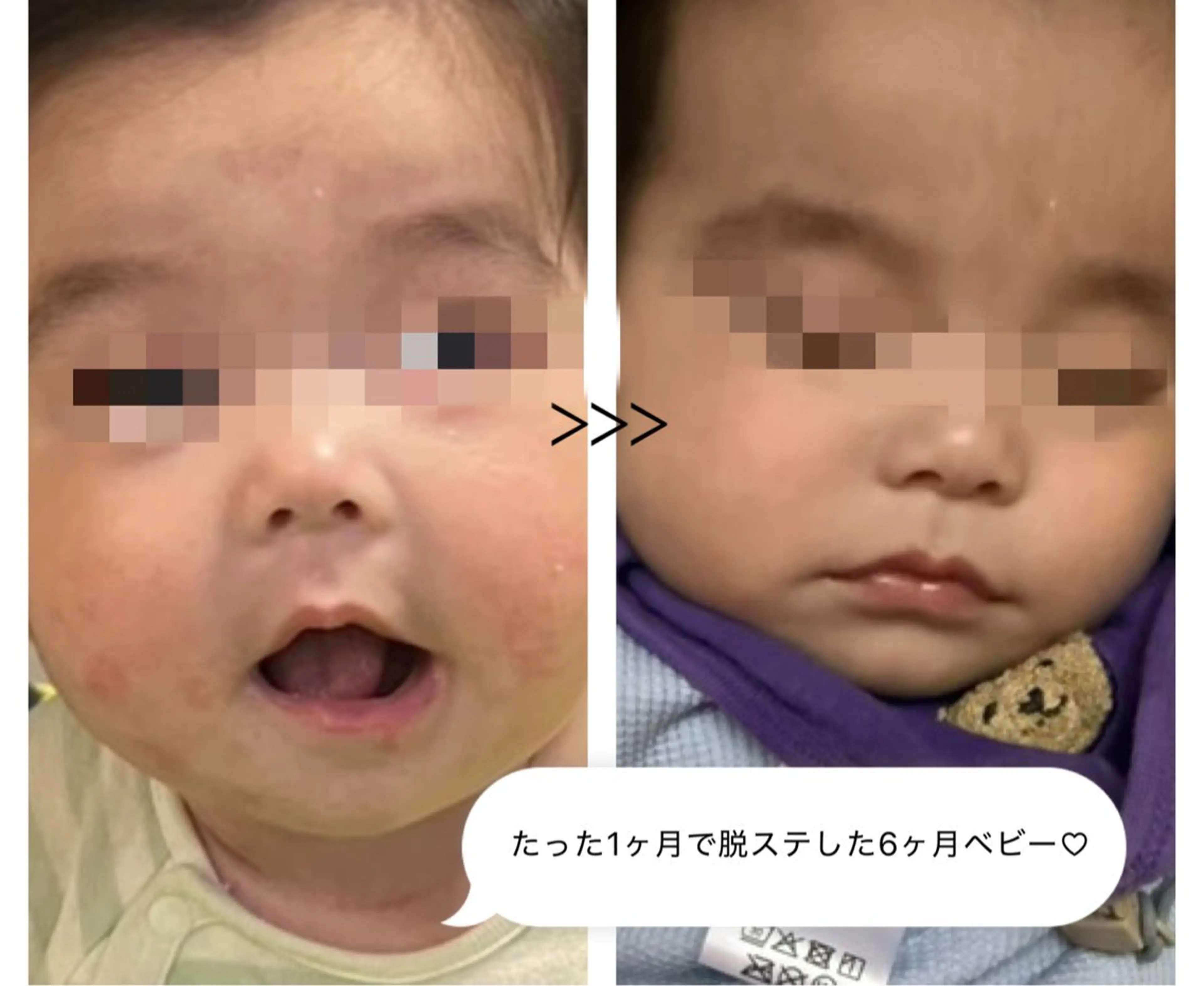 毛穴開き黒ずみ ニキビ特化💆‍♀️のエステ・リラクイメージ