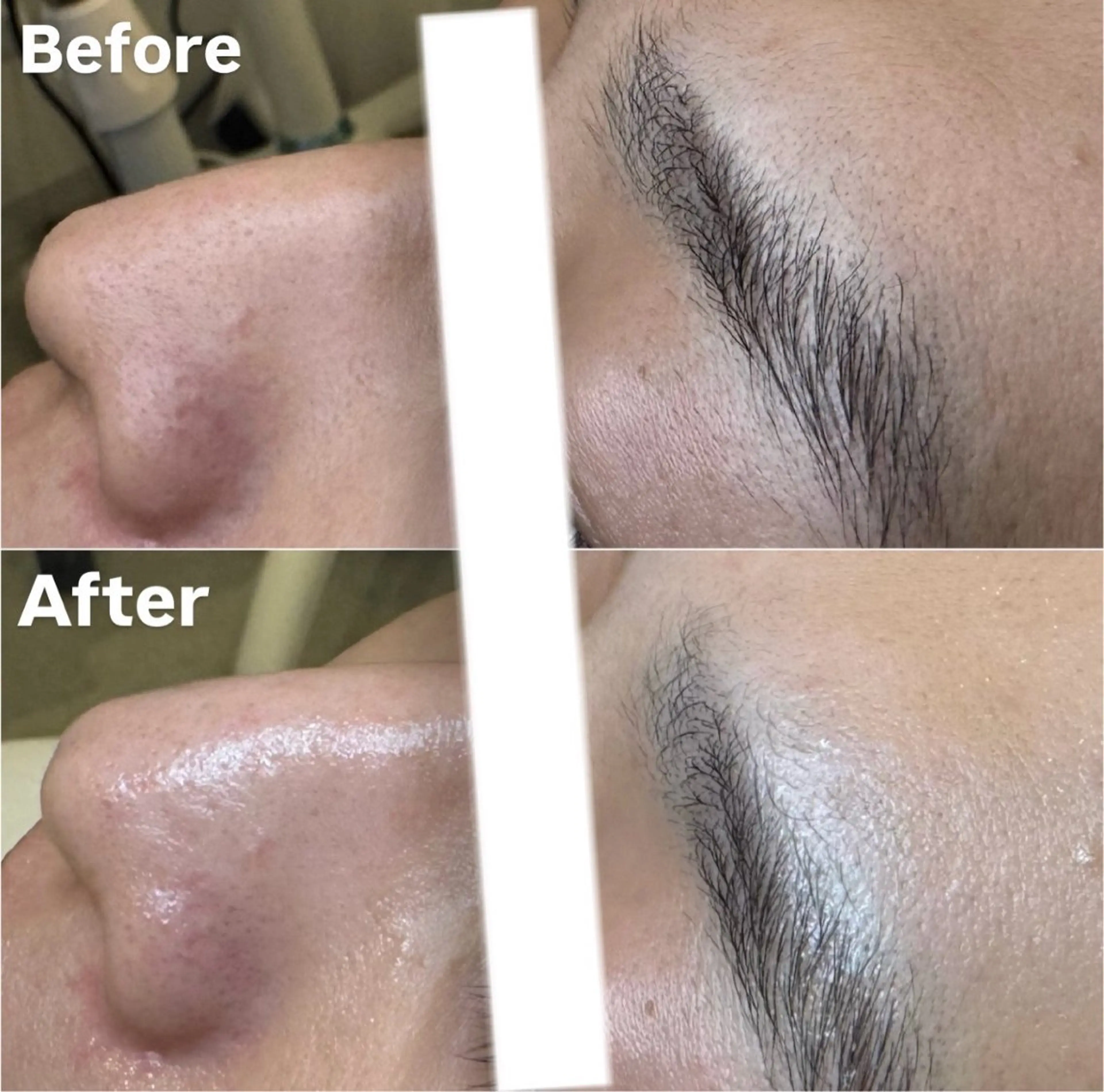 メンズ大歓迎！【毛穴洗浄で毛穴レス✨】ハイドラ毛穴洗浄で皮脂汚れスッキリ！の写真