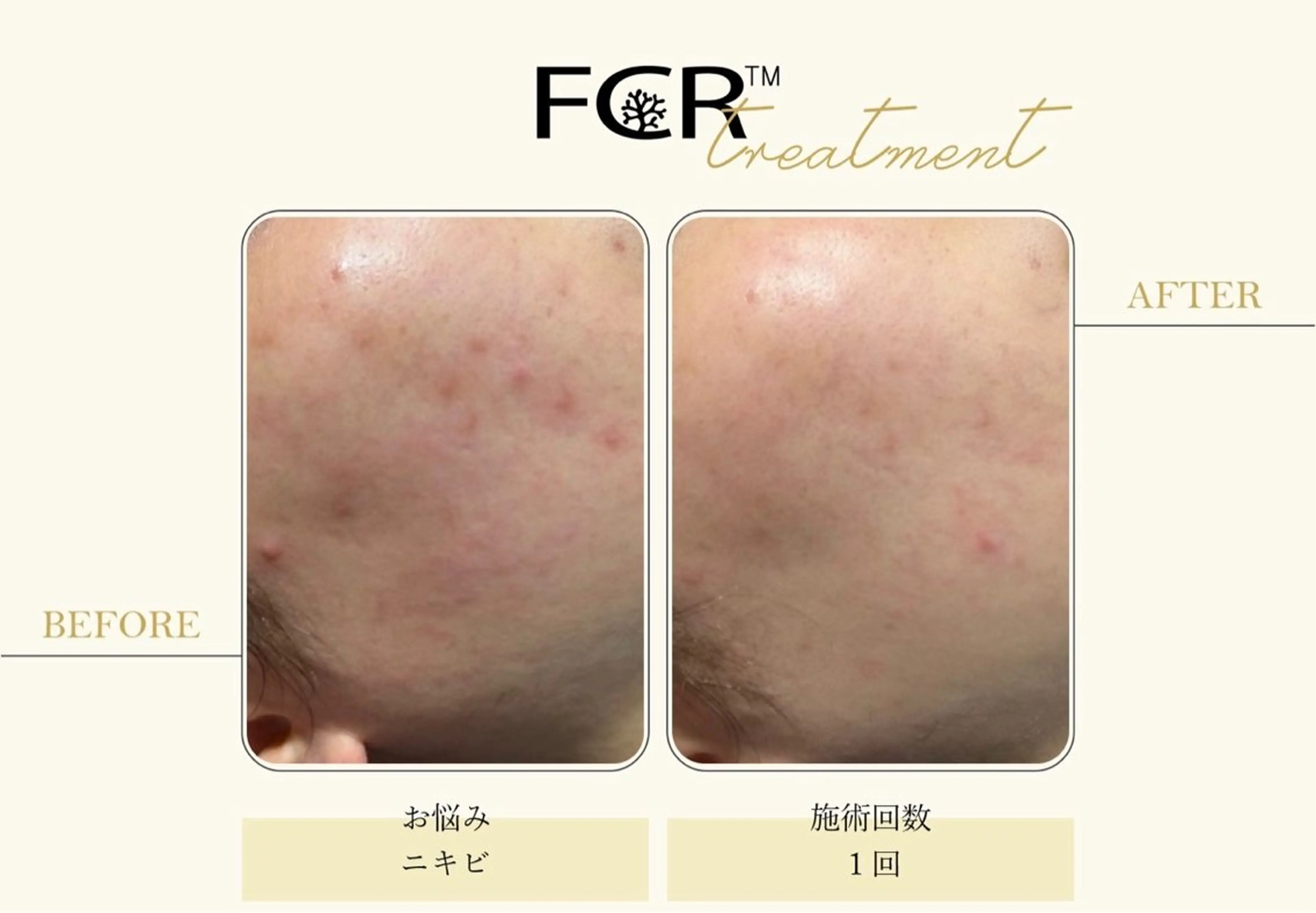 ニキビ改善シャルム ココハーブピーリングのエステ・リラクイメージ