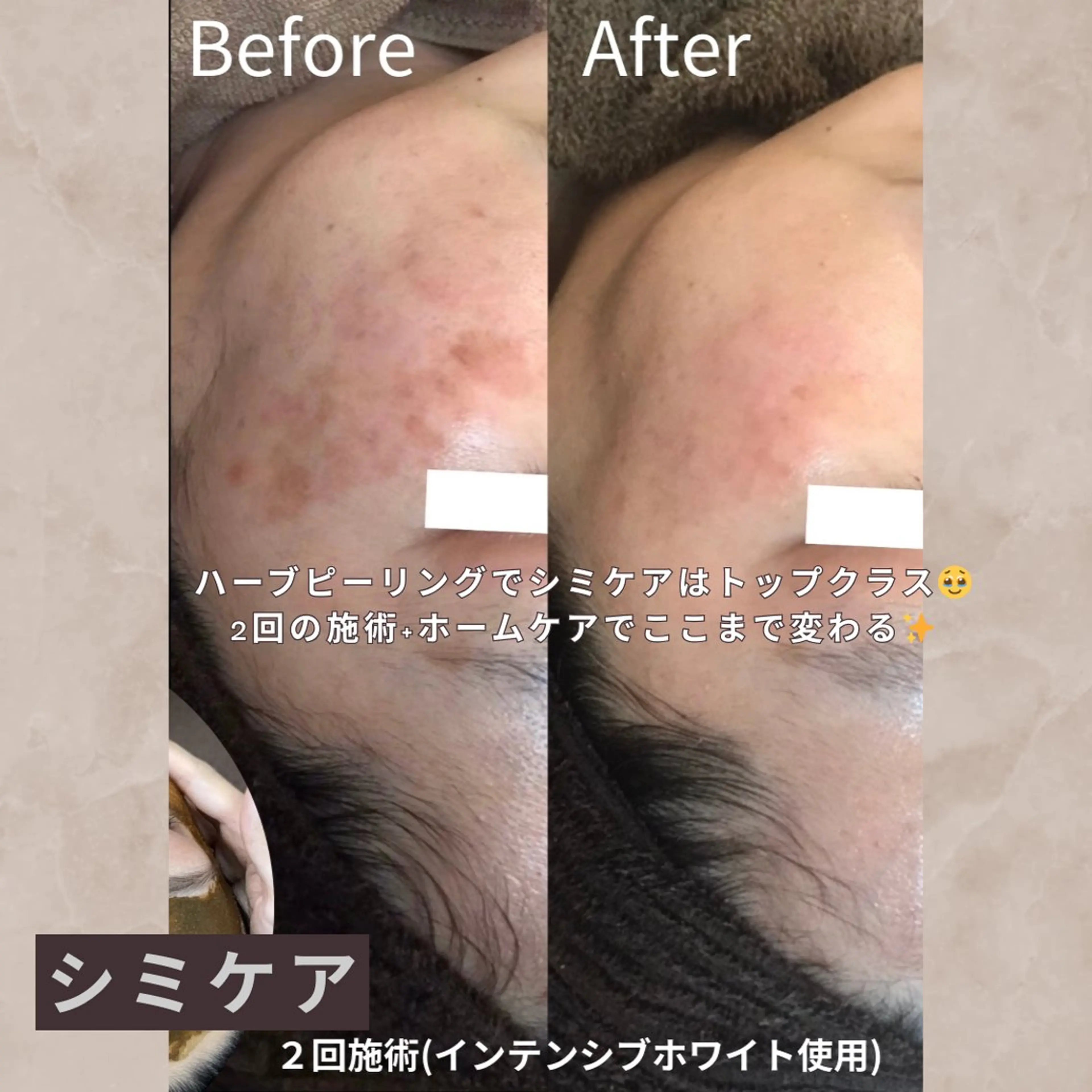 【シミ/しわ/肝斑/そばかすコース】初回/ダウンタイム/痛み無し✖️通常¥18000ドクターハーブピーリング🌿90分の写真