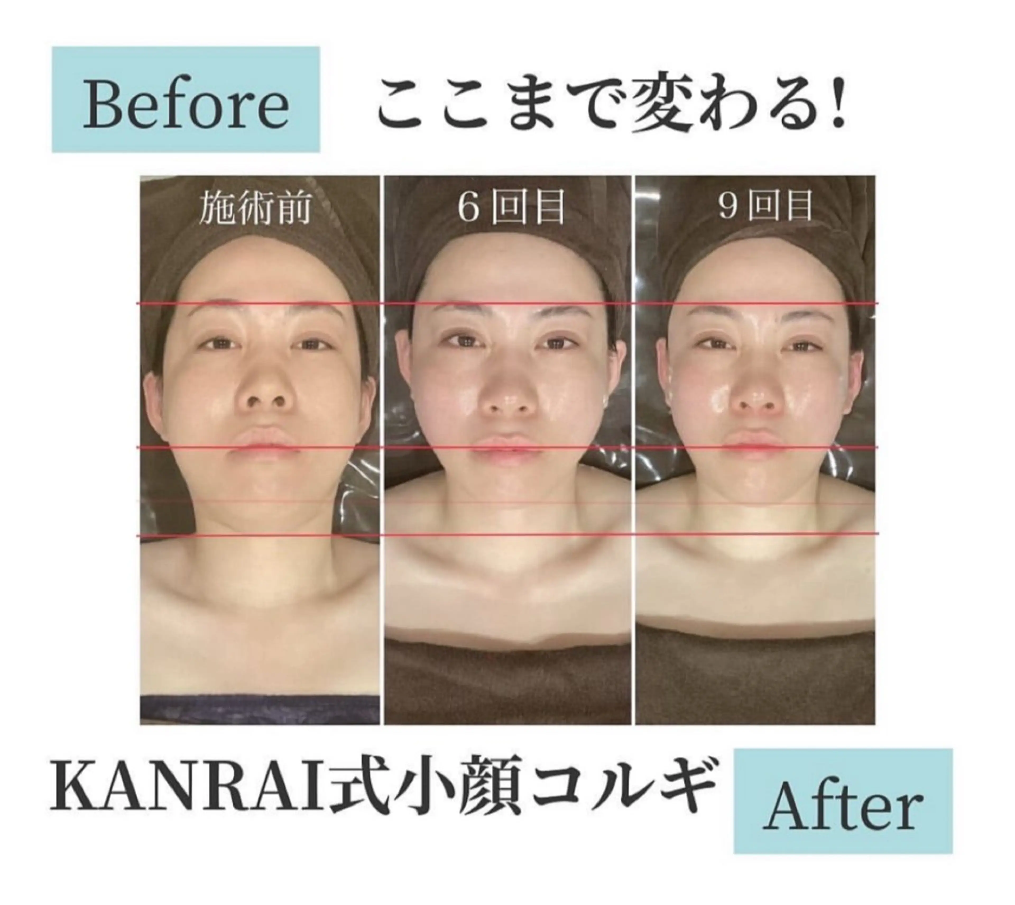 【自分史上No.１の小顔に】小顔コルギ➕上半身コルギ　※SNS掲載OKの方（施術時間45分）の写真
