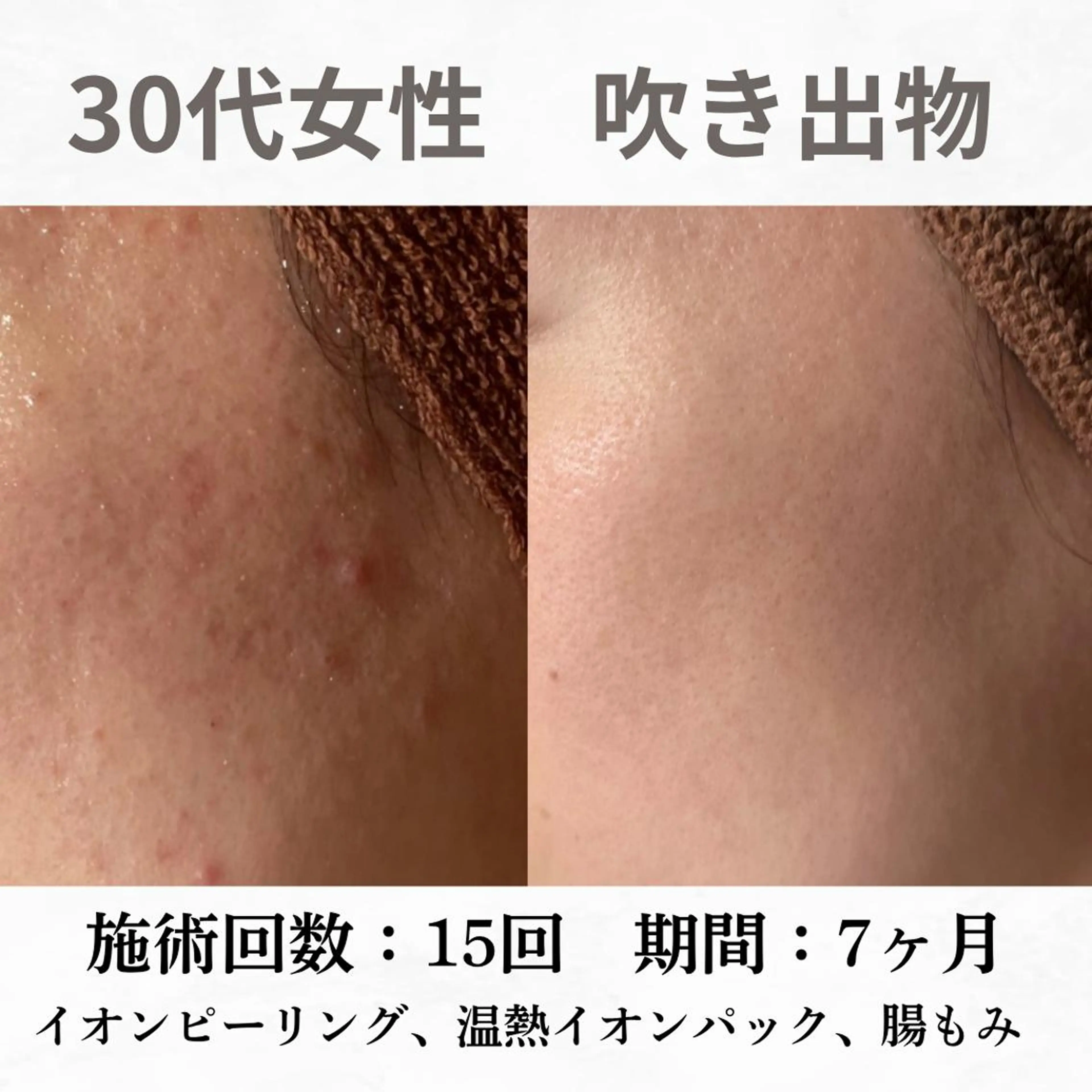 重度ニキビ専門🌷 ダウンタイムなしのエステ・リラクイメージ