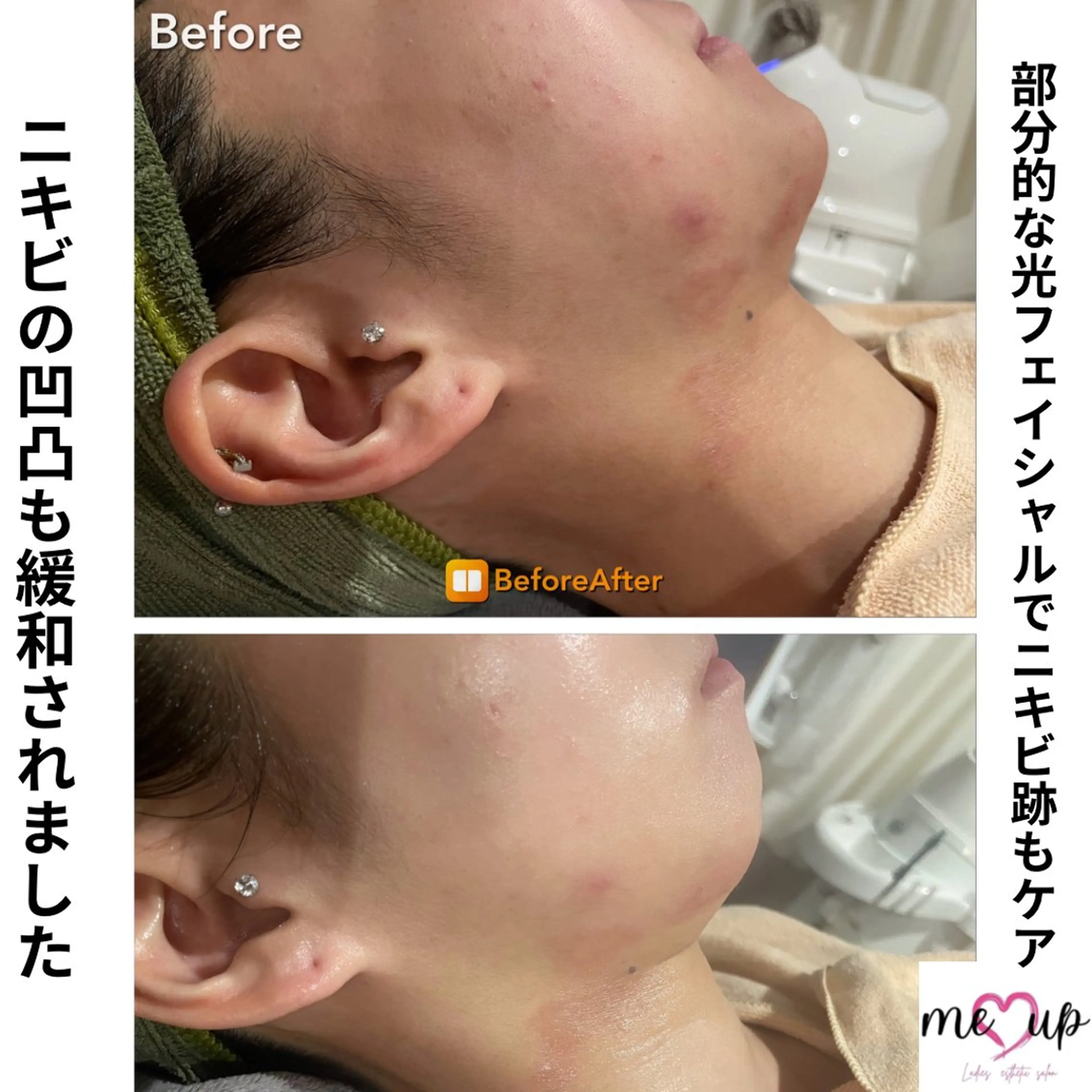 Meupニキビ専門店 背中/ハーブ/肌管理のその他イメージ