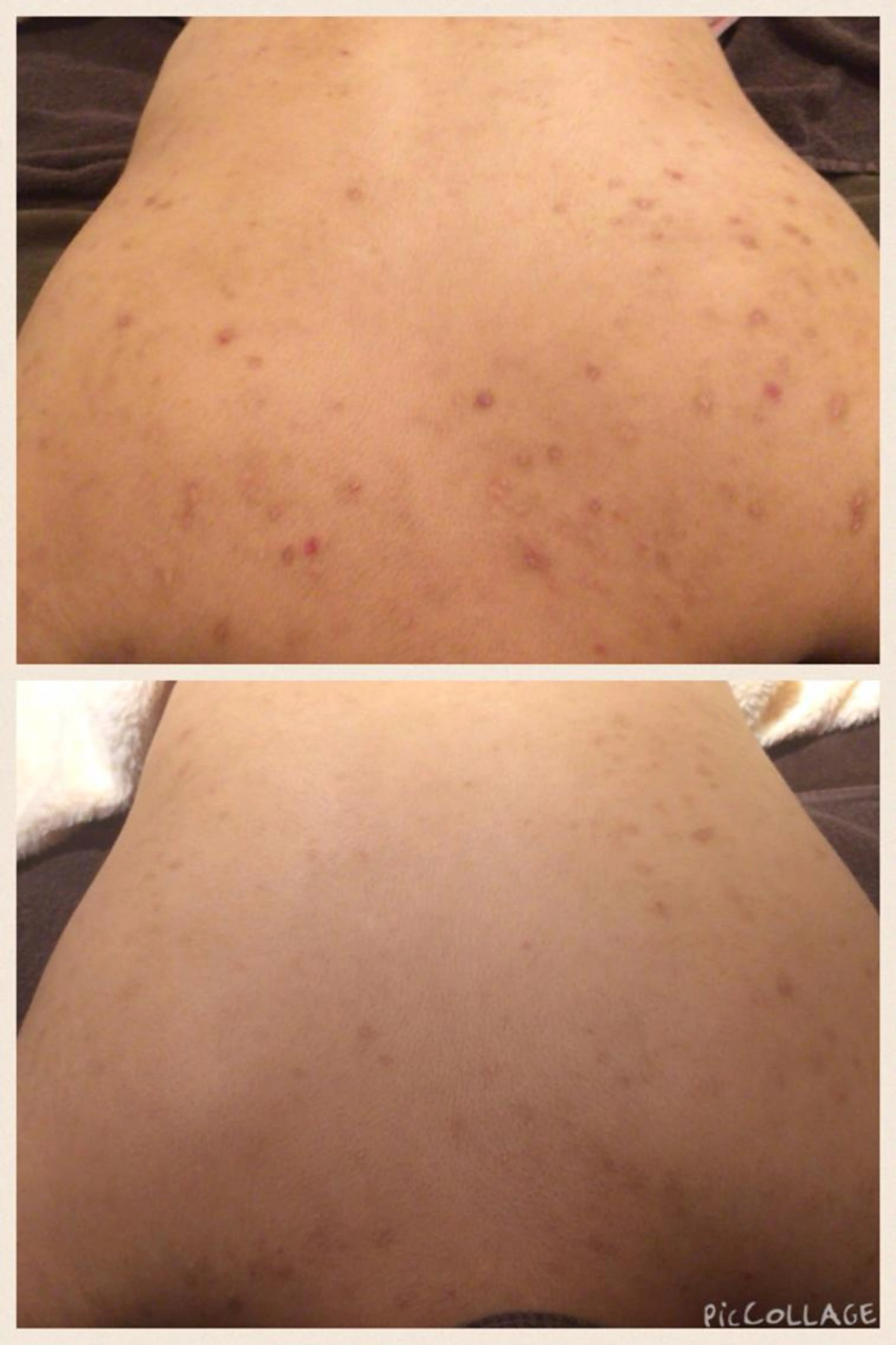 限定《ニキビ撲滅❣️剥離なし背中ピーリング＆鎮静パック》ブライダルにも⭕️の写真