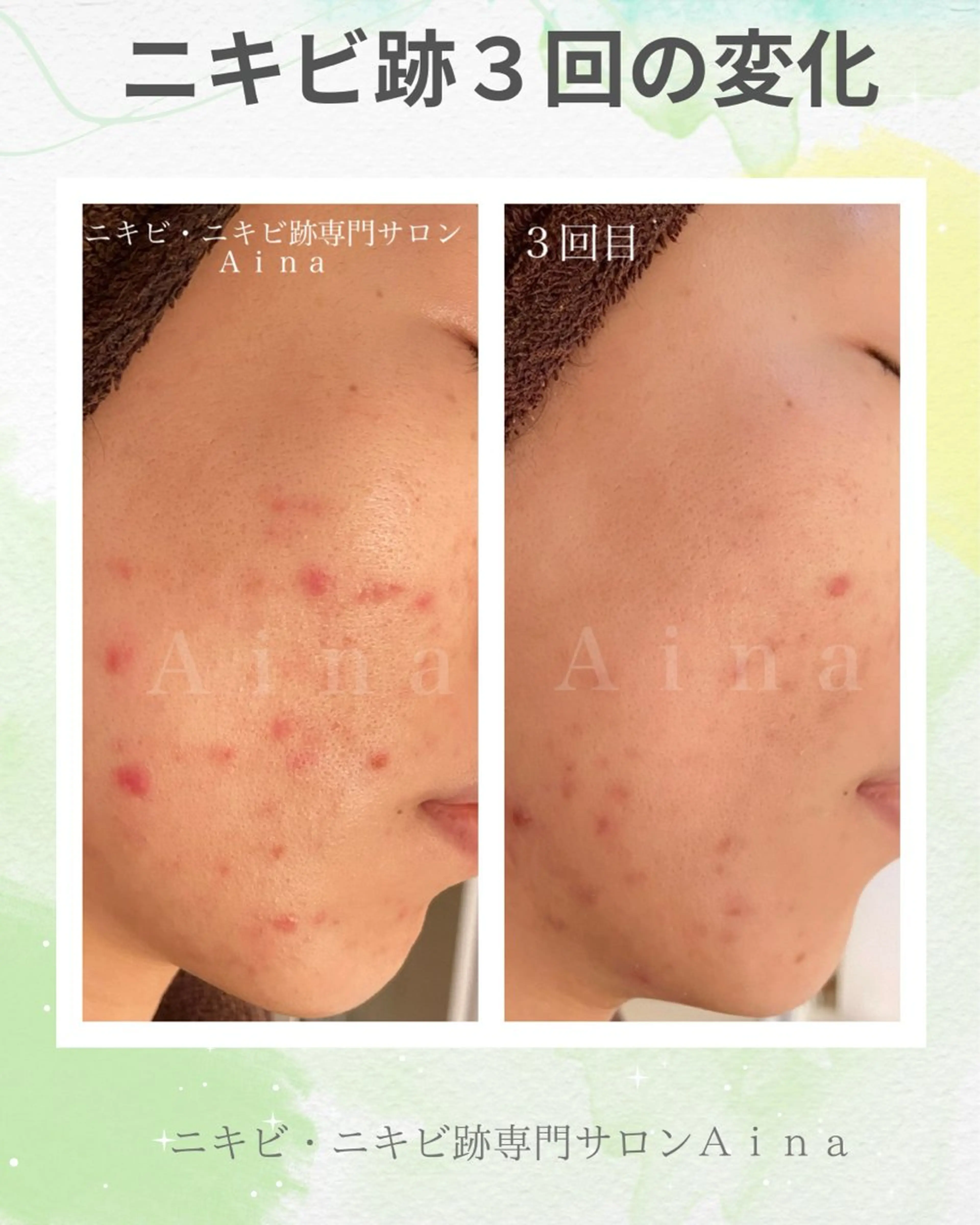 エステ リラク ニキビ跡専門サロン Ａｉｎａのエステ・リラクイメージ