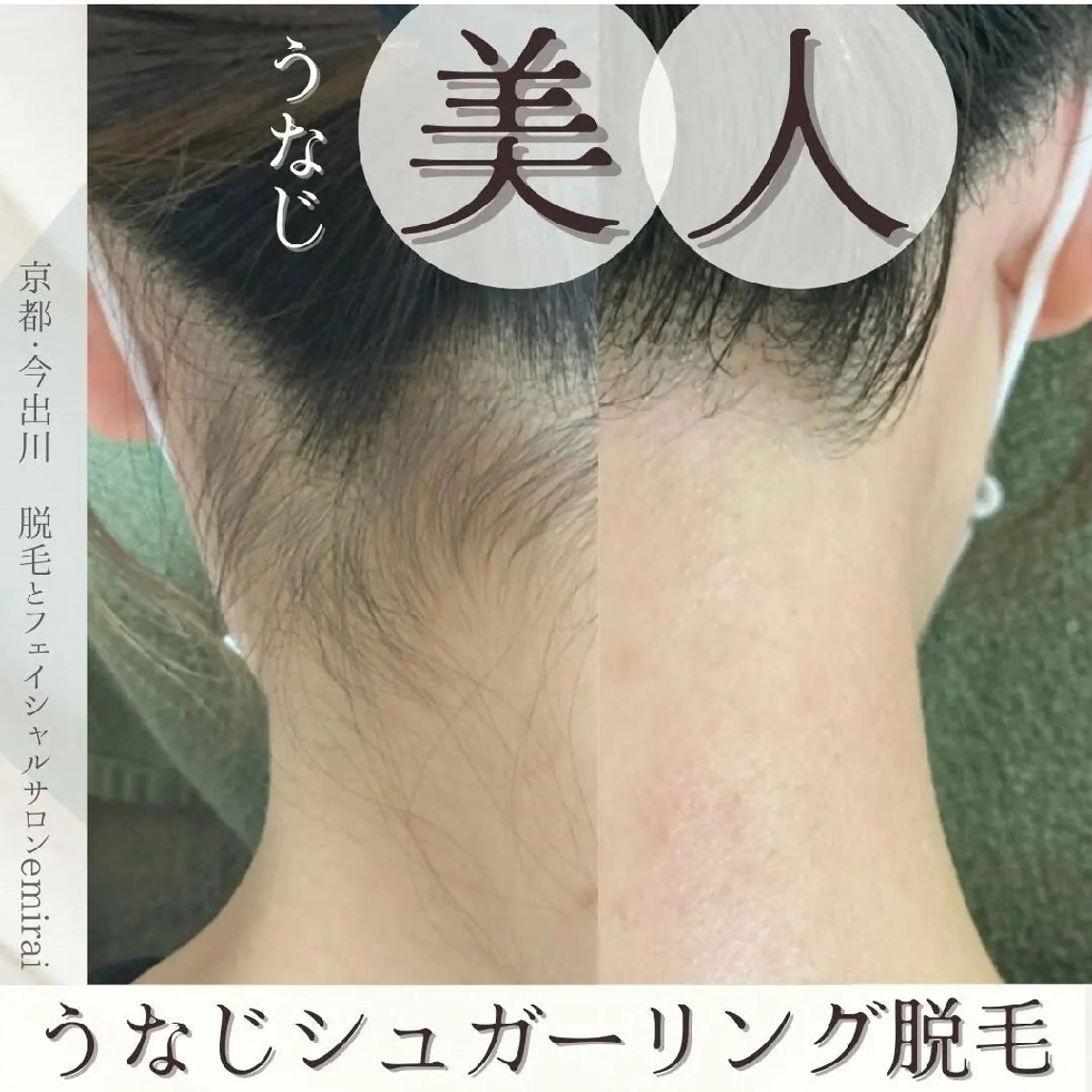 うなじシュガーリングmix脱毛でその日からつるつる✨の写真