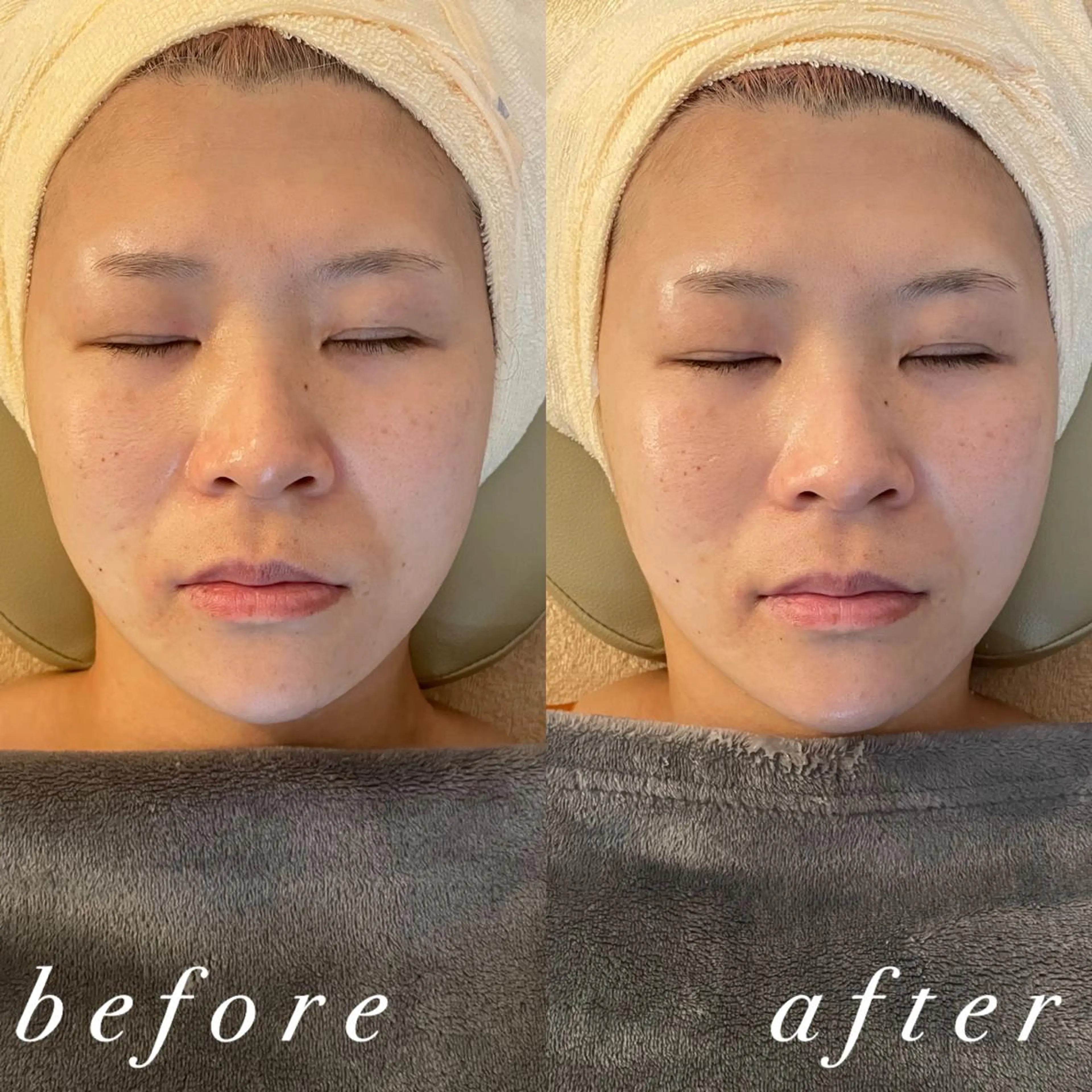 うなじ脱毛/美肌脱毛 LABELのエステ・リラクイメージ