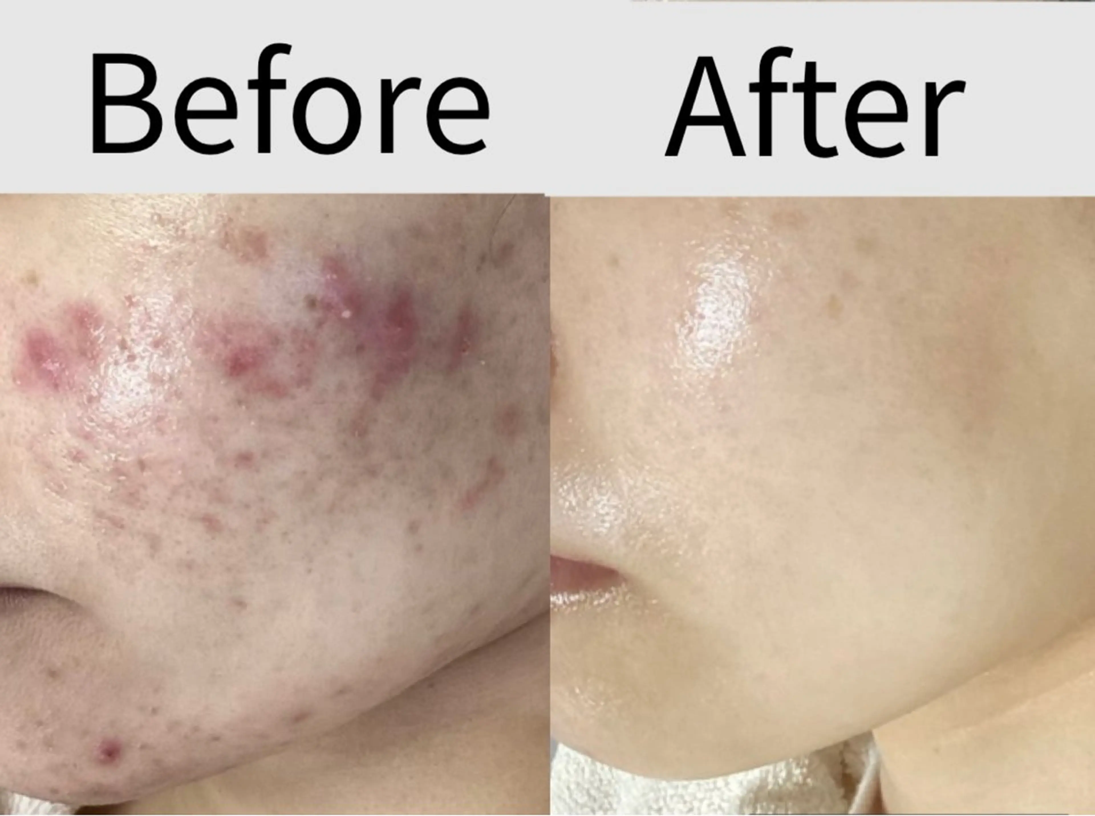 【効果No1🏅】本気の肌結果！最強コース　どんな肌悩みにも💆‍♀️ 生コラーゲンパック付の写真