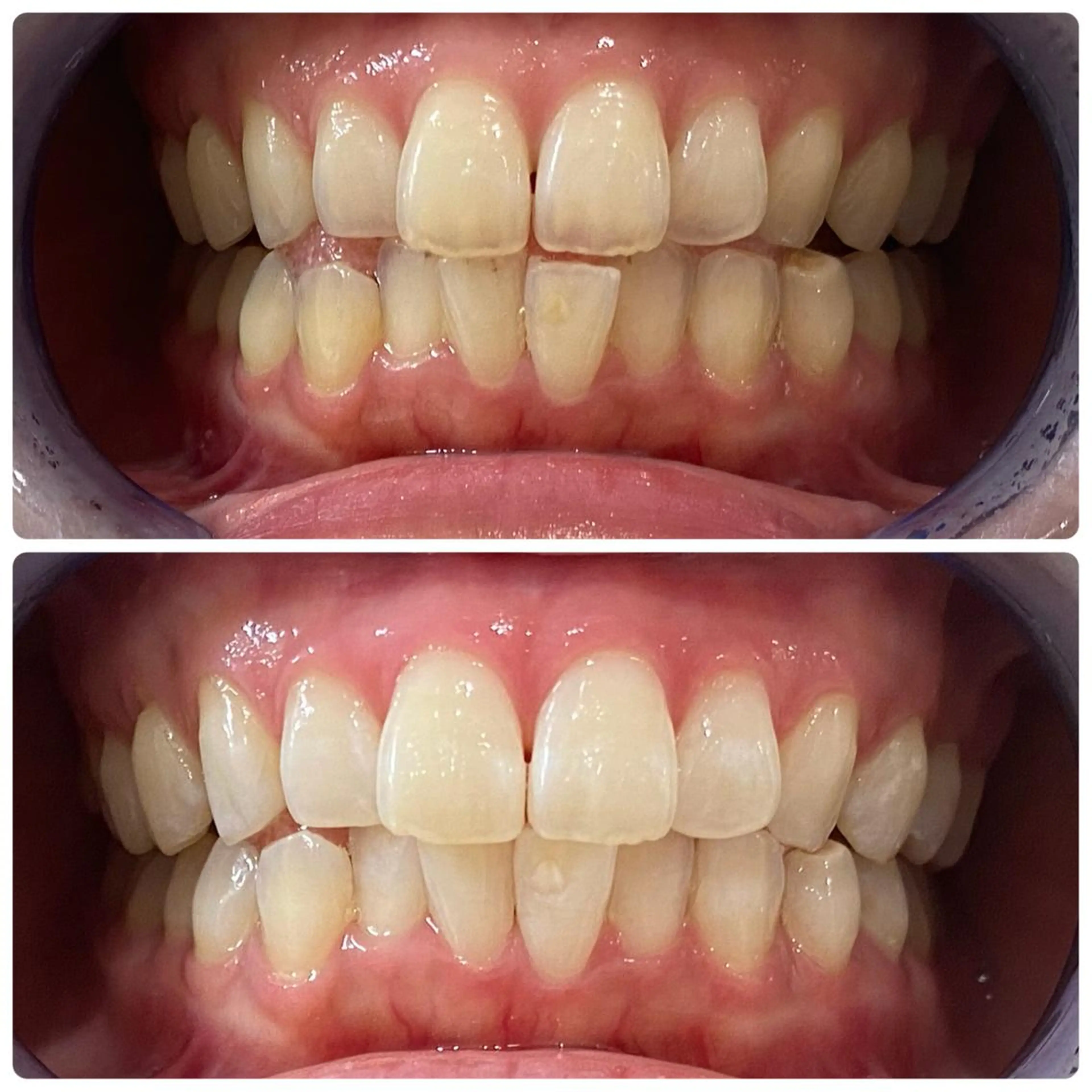 その他 セルフホワイトニング 🦷口元垢抜け✨のその他イメージ