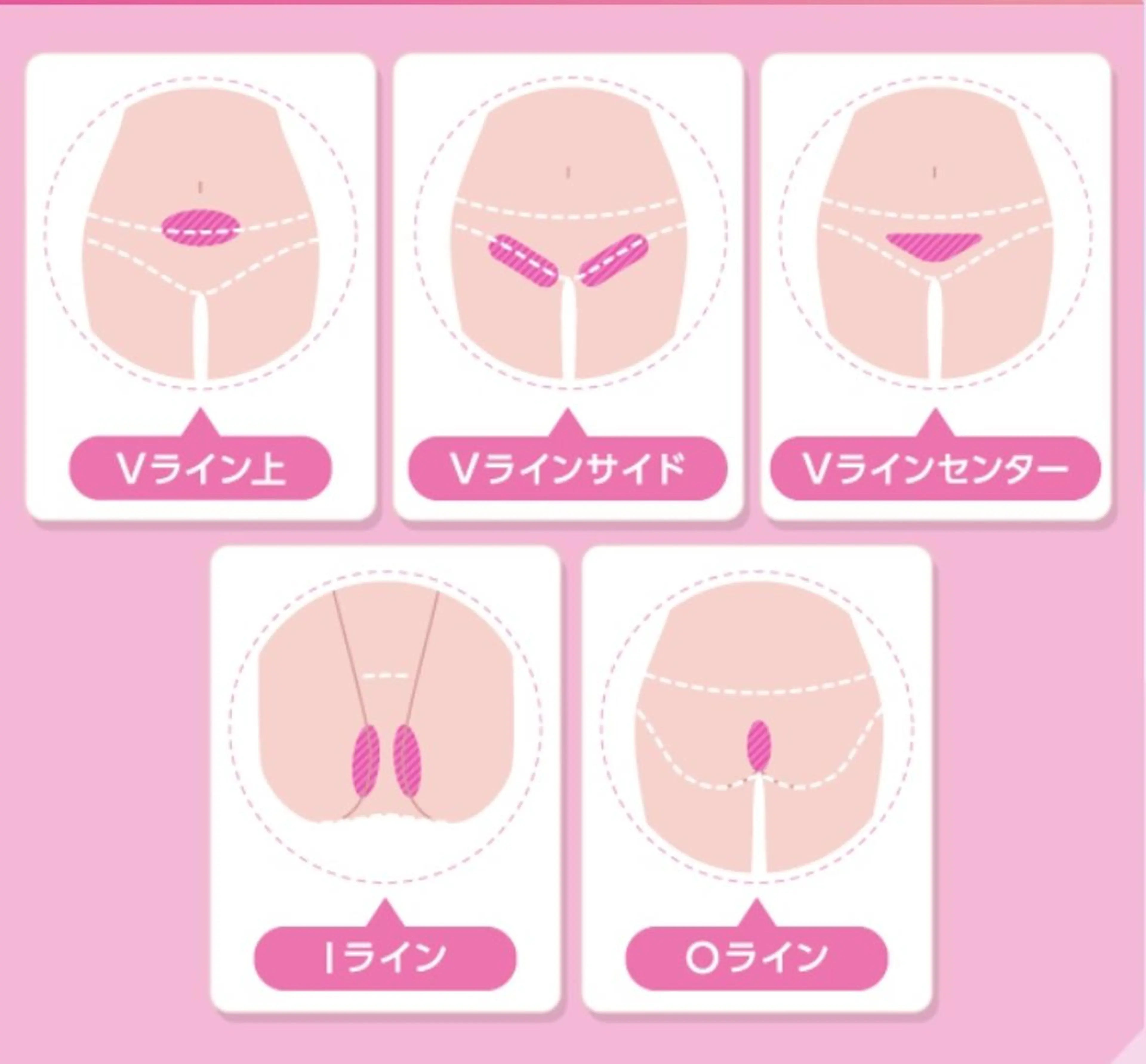 ８５％オフ💓VIO脱毛💓二段階シェービング付✨抜け落ち抜群・IPL脱毛！目指せ！ワックスからの卒業✨の写真