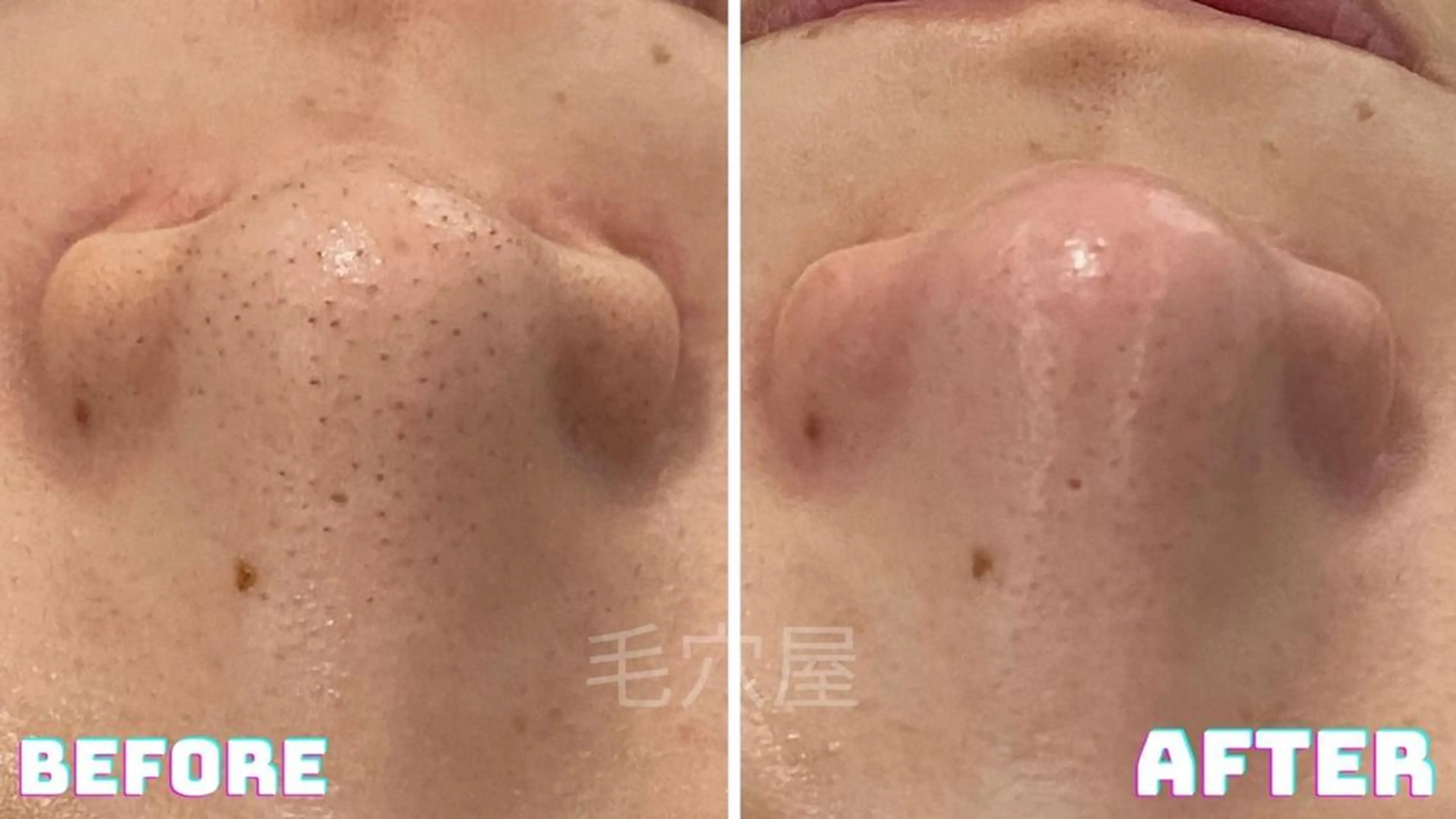 エステ 毛穴/毛穴洗浄専門 エミルカ船橋のエステ・リラクイメージ