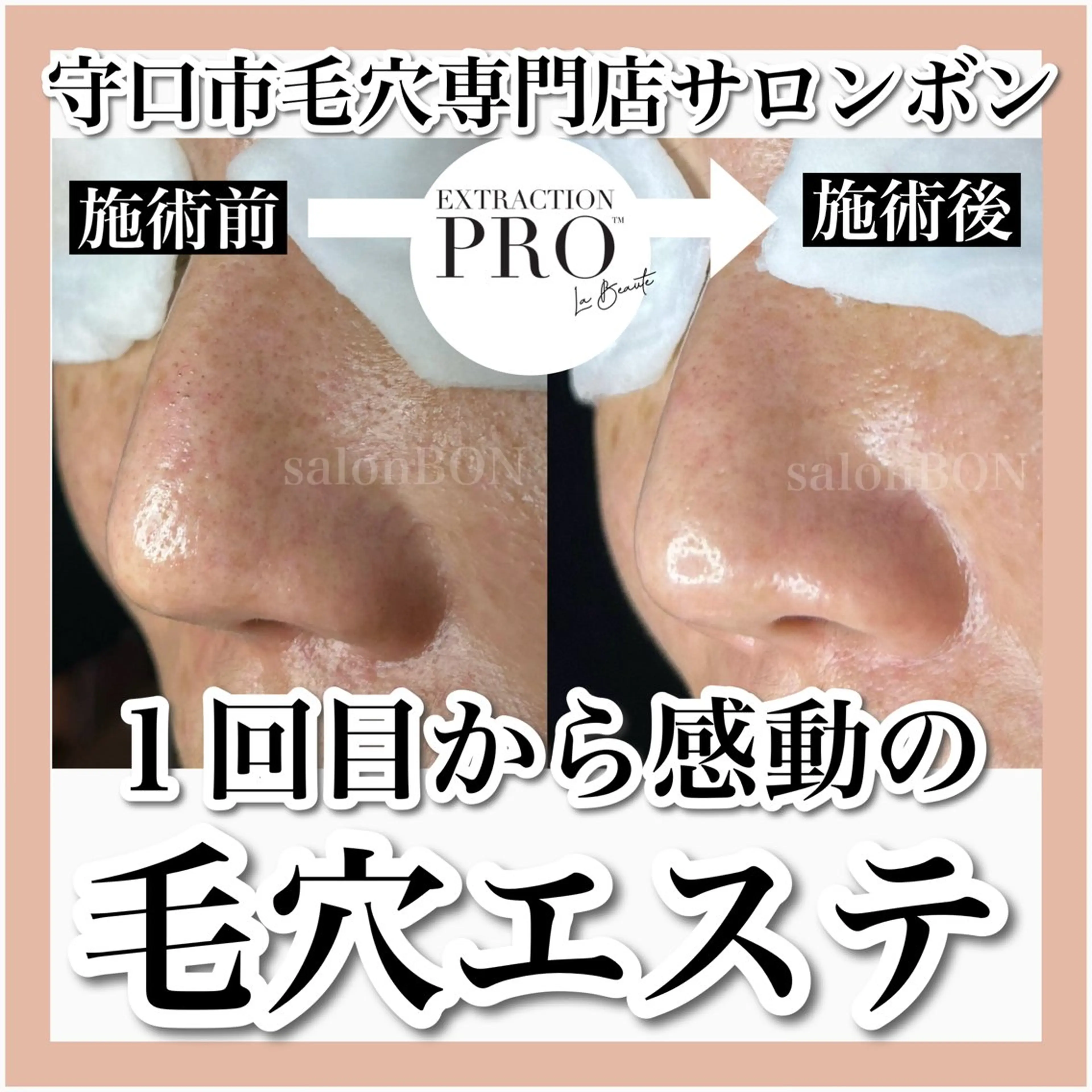 艶肌✨毛穴改善コースの写真